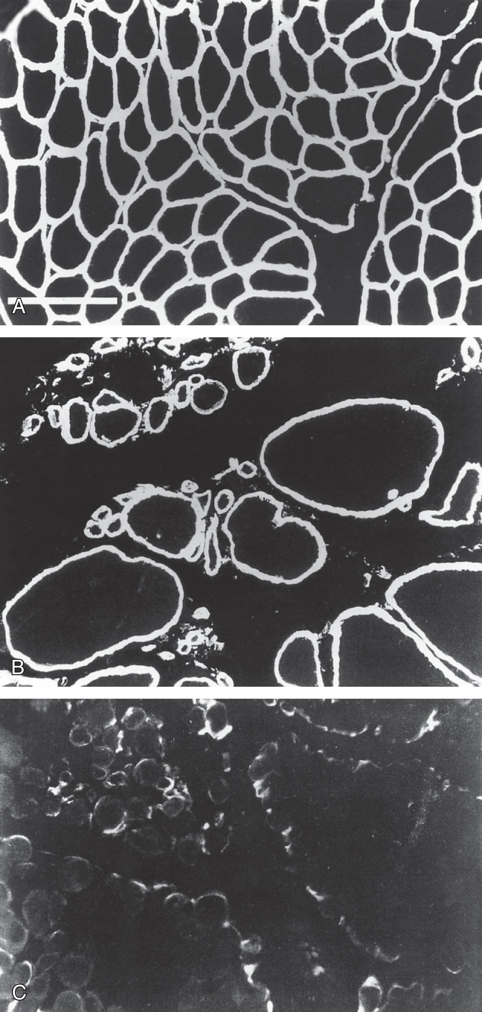 Fig. 37.11, Immunofluorescence analysis for merosin . (A) Normal muscle. (B) and (C) Muscle from two infants with congenital muscular dystrophy. (A) Normal muscle shows strong, continuous staining around the periphery of the myofibers. (B) Similar staining is evident in one of the infants with congenital muscular dystrophy, despite the marked variation in fiber size and increased connective tissue. Thus this infant has classic merosin-positive congenital muscular dystrophy. In (C) however, minimal staining for merosin is apparent. This infant has merosin-deficient congenital muscular dystrophy.