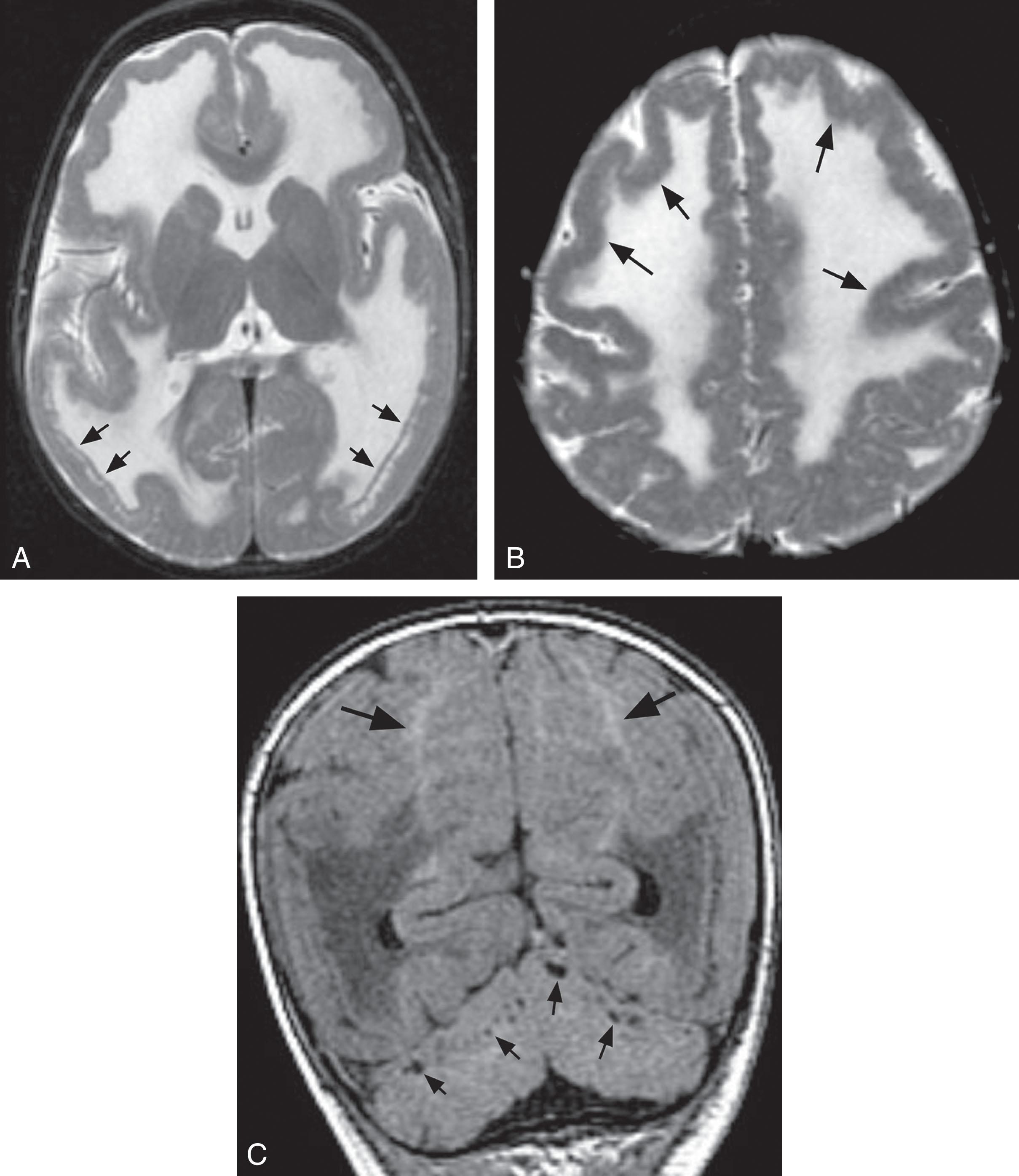 Fig. 37.12, Fukuyama congenital muscular dystrophy. (A) Axial T2-weighted image showing the occipital cobblestone cortex, which is thick with a smooth outer surface but a slightly irregular inner surface. In addition, deep to the inner surface of the cortex, separated from the cortex by a layer of white matter, partly contiguous nodules of cortex (arrows) can be identified on high-resolution scans. Myelination (manifest as hypointensity on T2-weighted images) is almost completely missing in this 10-month-old infant. (B) Axial T2-weighted image at a higher level showing polymicrogyria of the frontal lobes (arrows). (C) Coronal T1-weighted image showing the characteristic cortical cysts in the cerebellar hemispheres (smaller arrows). In addition, note the subcortical myelination (hyperintensity of the white matter, large arrows) in the absence of deep white matter myelination.