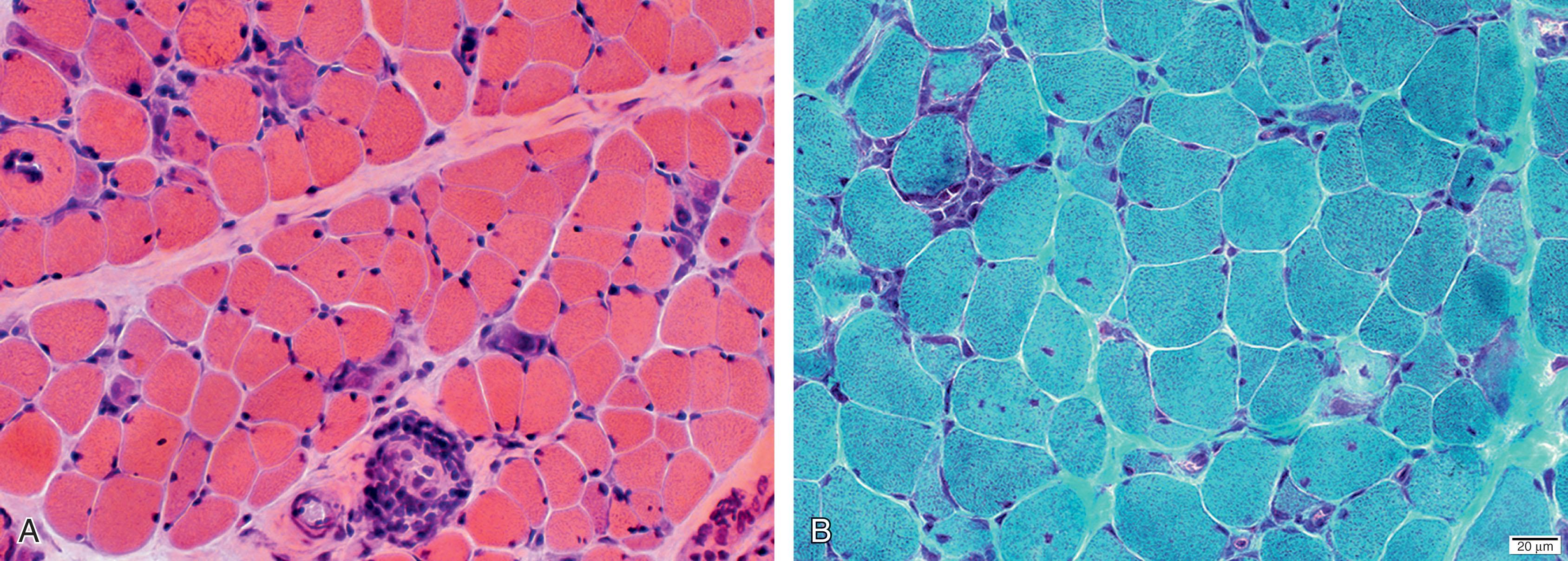 Fig. 37.14, Congenital facioscapulohumeral dystrophy . (A) Hemotoxylin and eosin stain. (B) Gomori trichrome stain. Note striking inflammatory response in muscle and significant variation in fiber size and many small basophilic fibers. In A, note mononuclear inflammatory cells around perimysial blood vessels.