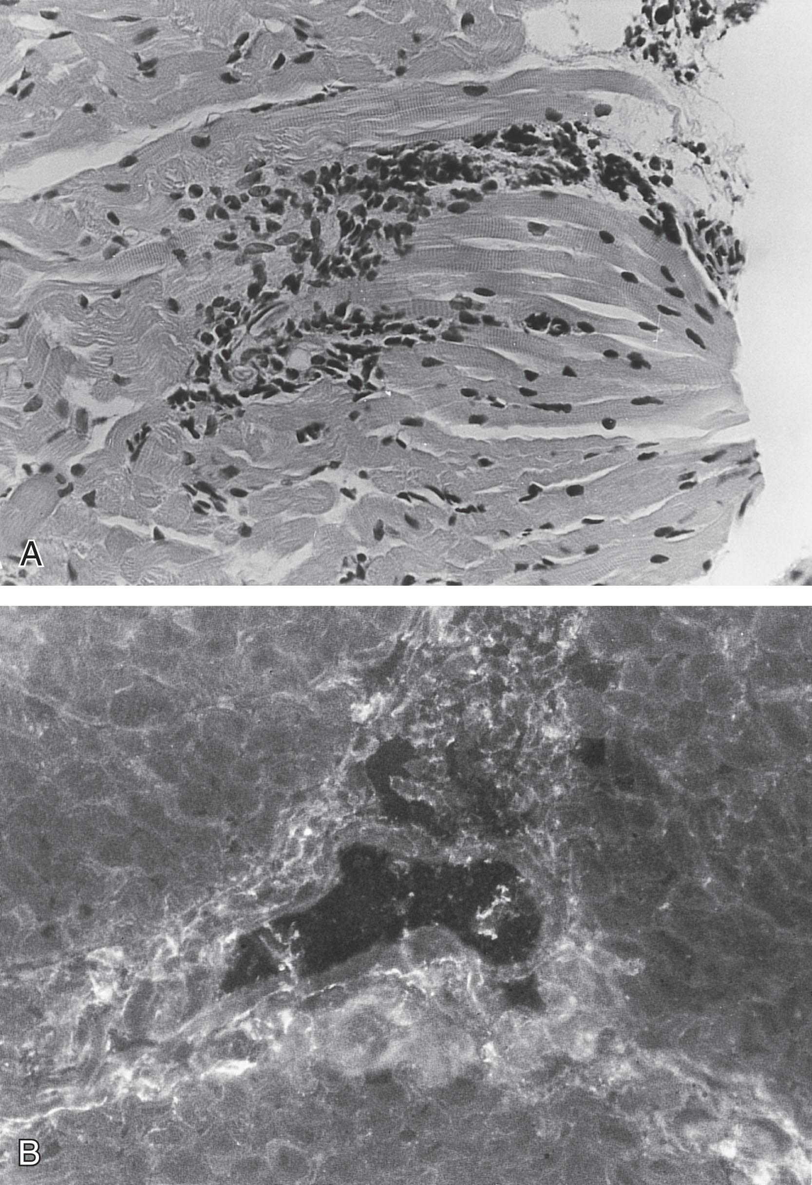 Fig. 37.16, Congenital polymyositis: muscle pathology . (A) Muscle biopsy shows focal inflammation. (B) Immunofluorescence microscopy for immunoglobulin G documents immune complex deposition in a ringlike pattern around individual atrophic muscle fibers.