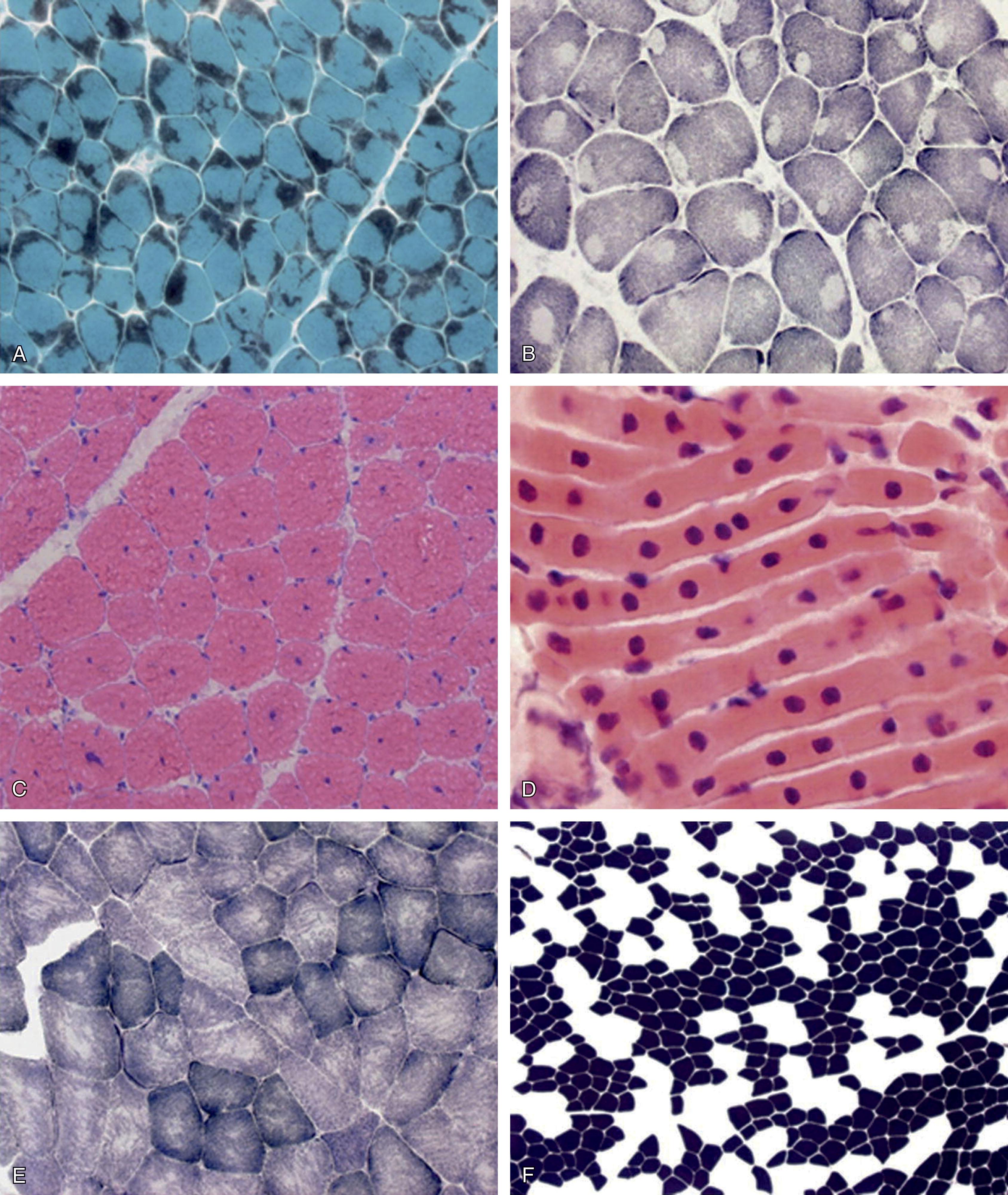 Fig. 37.17, Pathological features that define the major subtypes of congenital myopathy . (A) Nemaline rods: Biopsy from patient with nemaline myopathy with a dominant mutation in the ACTA1 gene, showing clusters of purple staining rods at the periphery of most fibers and some rods located internally within fibers (Gomori trichrome). (B) Central cores: Biopsy of the quadriceps from a 3-year-old patient with central core disease with a dominant mutation in the ryanodine receptor gene showing mild variation in fiber size (fiber diameter range 15–65 mm), fiber type uniformity and numerous cores of varying size centrally or peripherally (oxidative enzyme stain SDH). (C) Central nuclei: Quadriceps biopsy from a 28-year-old patient with autosomal dominant centronuclear myopathy due to a DNM2 mutation. The biopsy demonstrated small type 1 fibers and centrally placed nuclei in the majority of fibers (H&E). (D) Central nuclei (longitudinal section):Quadriceps biopsy from a case of X-linked myotubular myopathy aged 8 months showing large central nuclei. Note the widely spaced nuclei which affects the number seen in transverse section Most fibers are less than 10 mm in diameter. (E) Multiminicores: Areas in both fiber types of varying size and number devoid of oxidative enzyme stain in a quadriceps biopsy from a case of “multiminicore disease,” aged 11 years, with recessive mutations in the SEPN1 gene (NADH-TR). (F) Congenital fiber type disproportion with mutation in ACTA1: The only apparent pathology in this case was the small size of the dark-staining type 1 fibers and type 1 fiber predominance (ATPase preincubated at pH 4.3). Fiber diameter 25 to 70 mm.