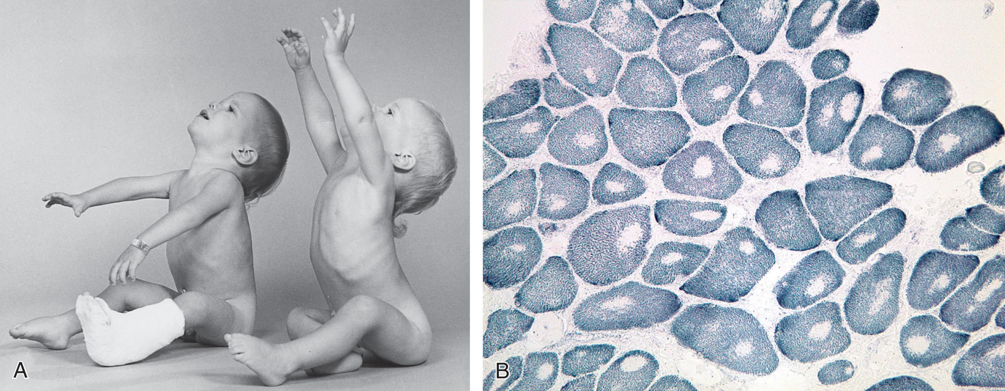 Fig. 37.18, Central core disease . (A) Photograph of twins, one of whom has the disease. Note the weakness of the proximal upper extremities. (B) Transverse section stained for NADH shows absence of enzyme activity in large central cores.