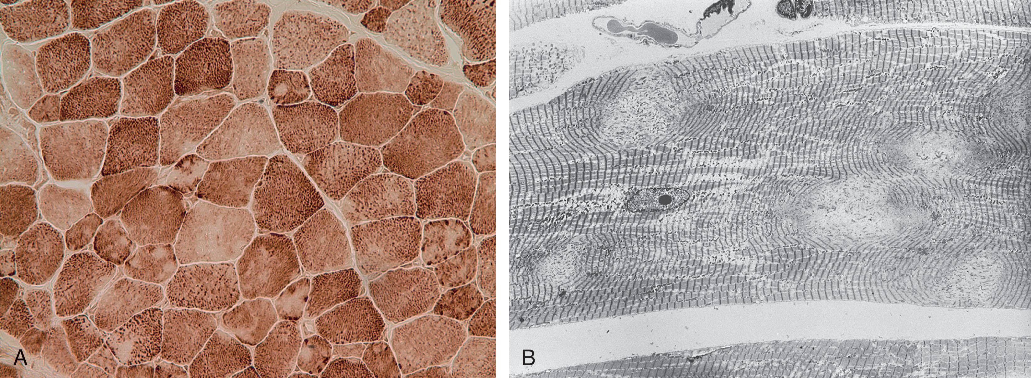 Fig. 37.19, Multiminicore myopathy . (A) Transverse section stained with NADH demonstrates foci of decreased oxidative enzyme activity throughout the muscle fiber. (B) Low-power electron microscopic view of longitudinal muscle sections demonstrates focal loss of cross striations, corresponding to areas of decreased mitochondrial enzyme activity.