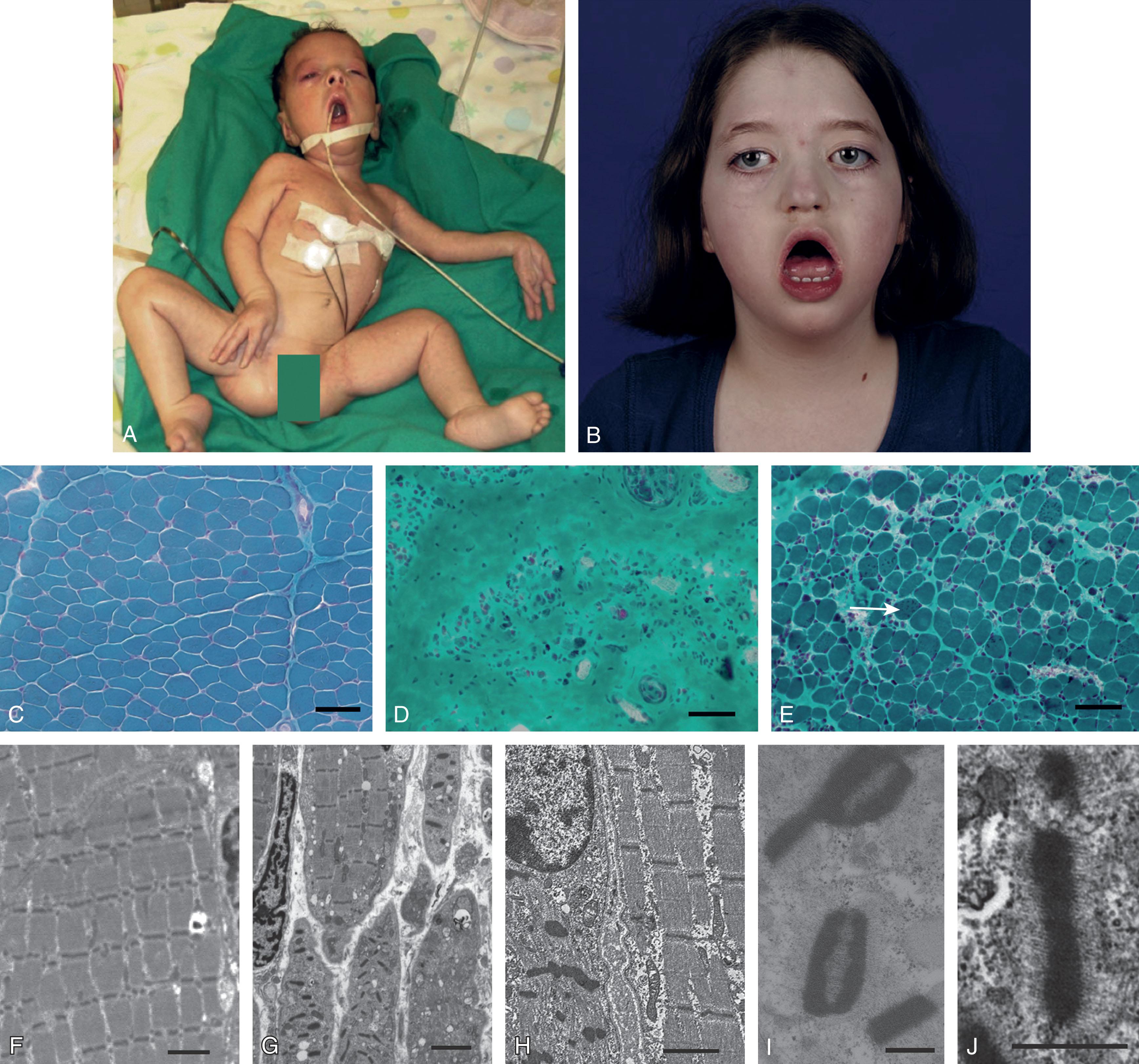 Fig. 37.20, Clinical and histological features in nemaline myopathy due to LMOD3 mutations . (A) and (B) Photographs of patients with LMOD3 nemaline myopathy. (A) Most affected individuals had severe generalized muscle weakness and hypotonia at birth and died in infancy (female patient with severe congenital nemaline myopathy, deceased at 4 months). (B) Female patient has less severe weakness and has survived into childhood (alive at 10 years). Note the severe facial and jaw weakness. (C) Control Gomori trichrome image (5-month-old child). (D) and (E) Skeletal muscle biopsy findings in (D) female patient alive at 1 year 7 months and (E) male patient alive at 4 months. (D) Some biopsies had only a few scattered atrophic myofibers within abundant connective tissue. Nemaline bodies appear as purple or blue inclusions ( arrow ). (F) Control electron microscopy image (6-week-old child, rectus abdominis muscle). (G) and (H) Electron microscopy images from some patient biopsies show myofibers with ordered sarcomeres adjacent to myofibers with disordered sarcomeres and thickened Z-discs. (I) and (J) Many nemaline bodies appear as thickened Z-discs, (I) sometimes in pairs interconnected by thin filaments. Some nemaline bodies resemble thickened Z-discs surrounded by a short thin filament “fringe.” Scale bar: 50 μm (C)–(E); 2 μm (F)–(H); 500 nm (I) and (J).