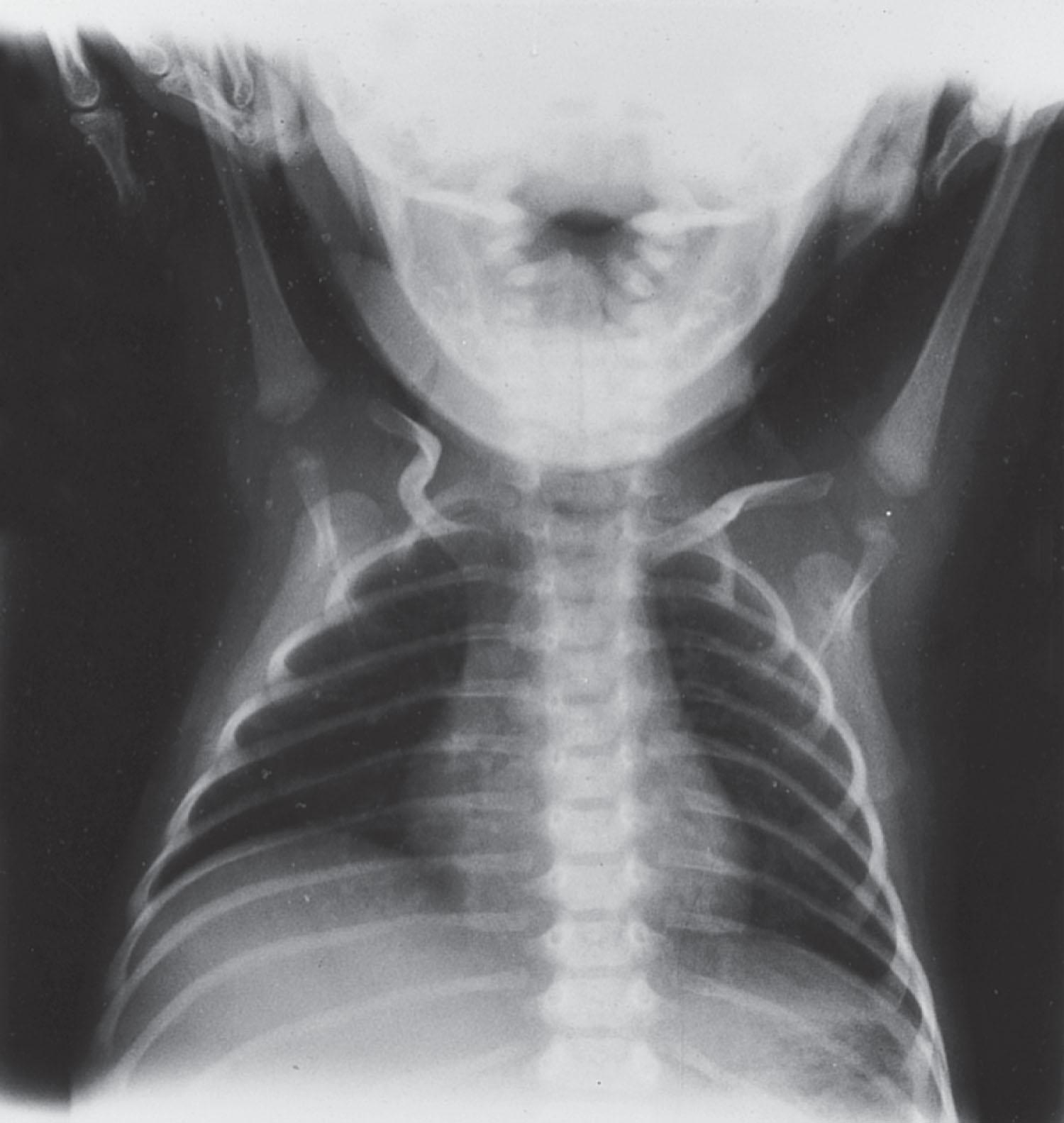 Fig. 37.2, Congenital myotonic dystrophy: diaphragmatic involvement . This radiograph of the chest is from a newborn with congenital myotonic dystrophy. The right hemidiaphragm is elevated and paralyzed. Note also the thin ribs, characteristic of severe congenital neuromuscular disease.