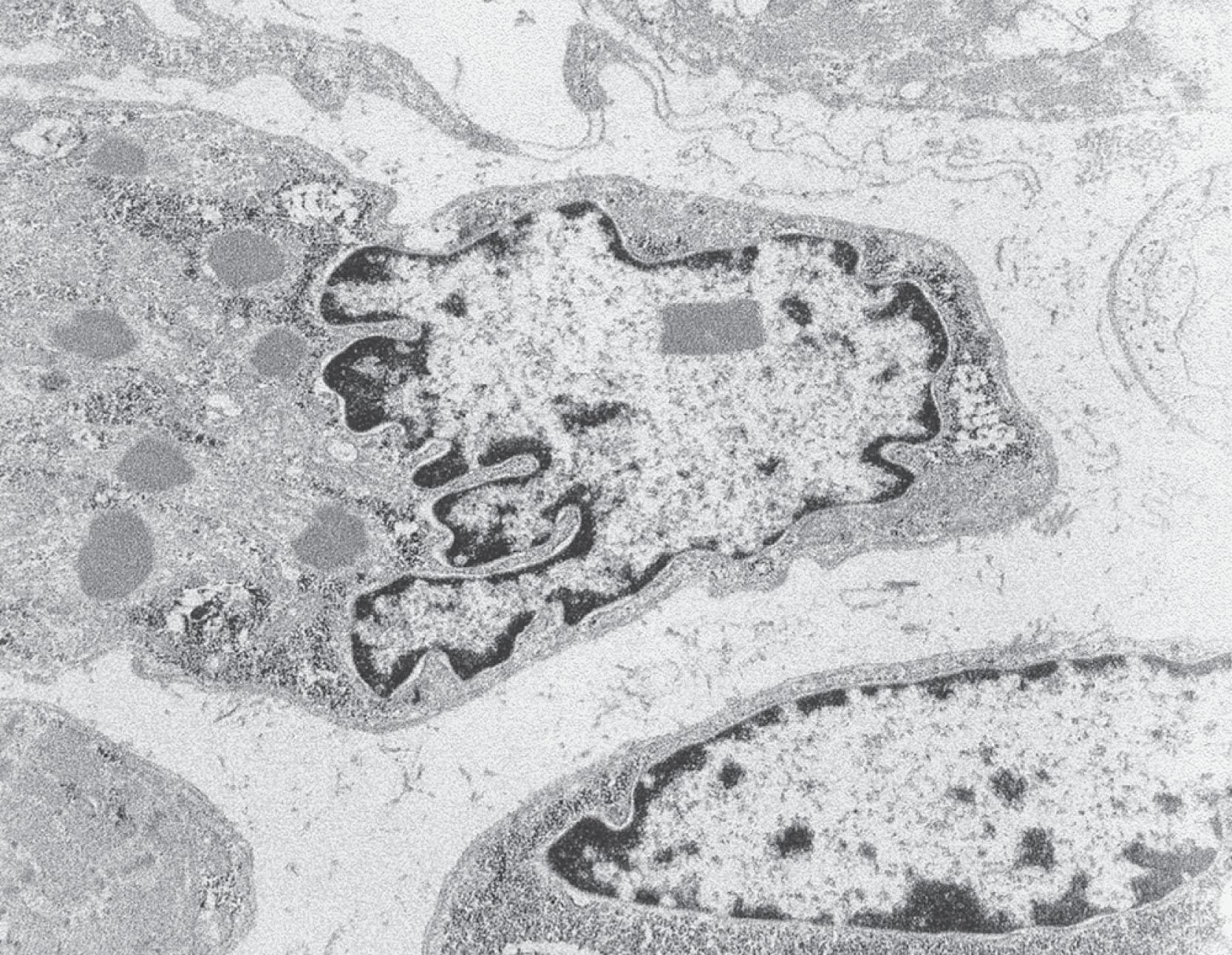 Fig. 37.23, Nemaline myopathy . Electron micrograph showing intranuclear rod in a single nucleus. Rods are also present in the adjacent muscle fiber, where there is loss of the regular sarcomeric structure (×36,000).