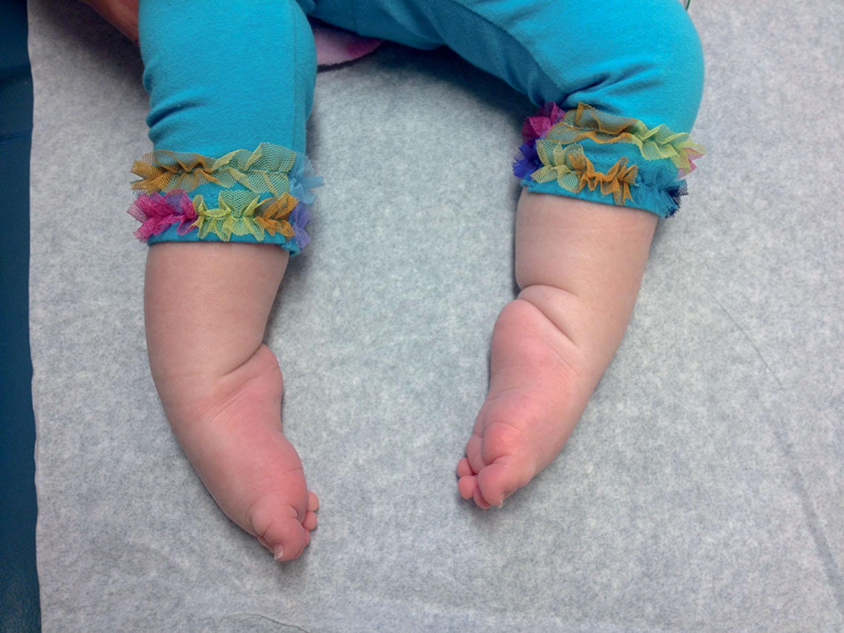 Fig. 37.3, Congenital myotonic dystrophy: club feet . This affected infant exhibits contractures at the ankles (club feet).