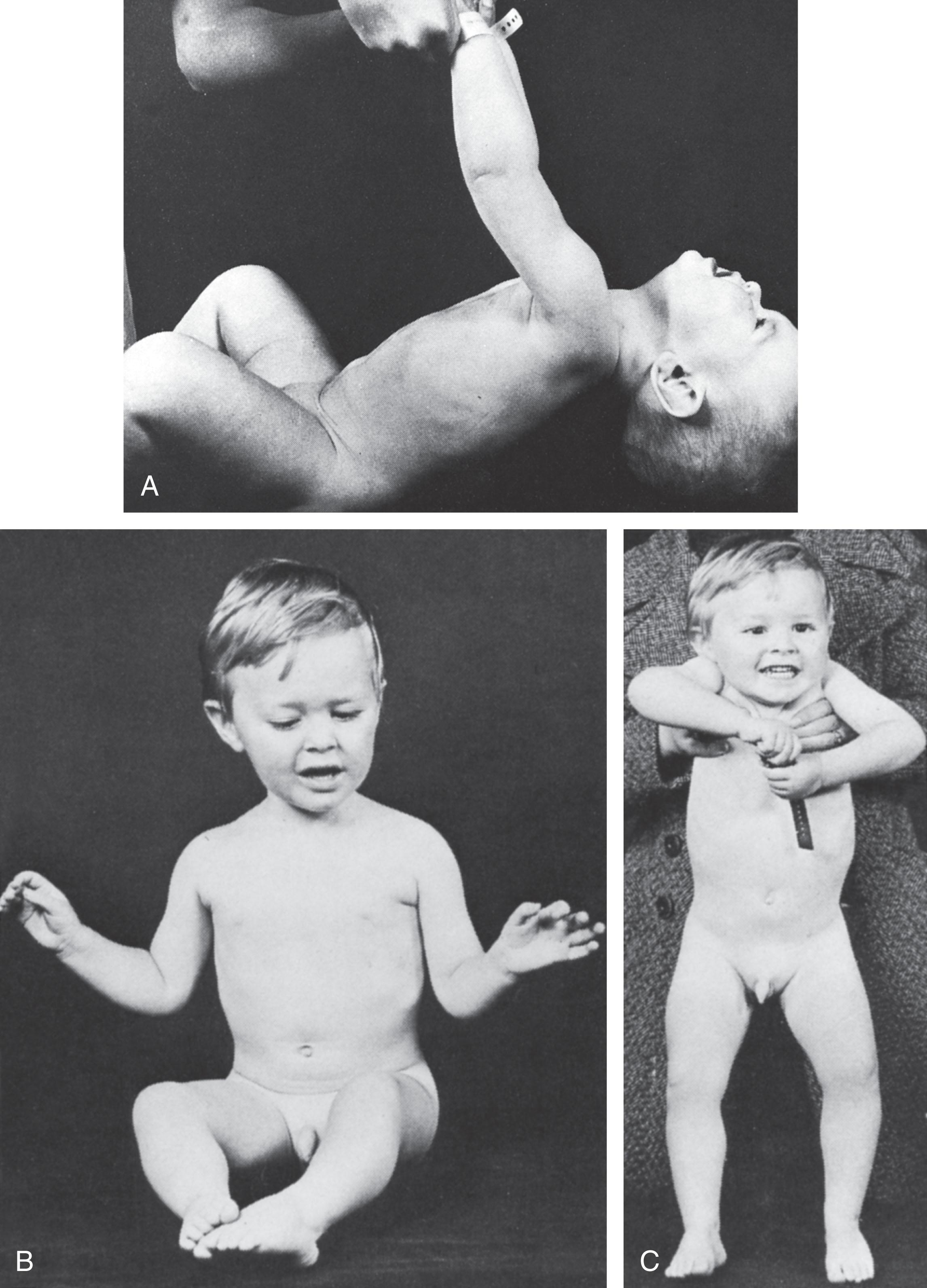 Fig. 37.4, Clinical improvement in congenital muscular dystrophy . (A) A 9-month-old boy with weakness and hypotonia from birth. Note the marked head lag with pull to sit. The infant cannot sit without support or support his body weight on his legs. (B) and (C) The same child at 2 years of age. He can sit without support and can bear considerable weight when standing with support.