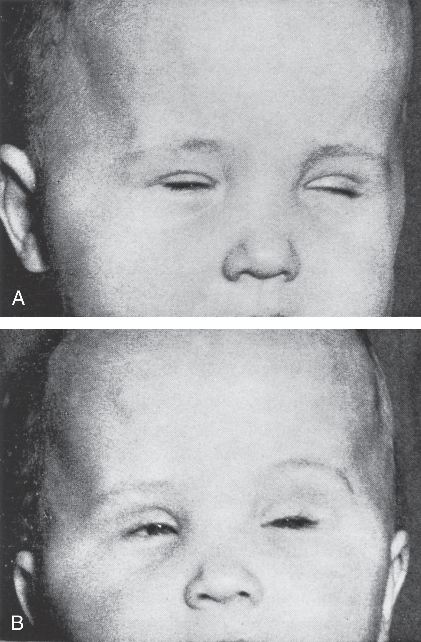 Fig. 37.5, Clinical myotonia in an 11-month-old infant . (A) Blinking was precipitated by a bright flash of light. (B) This photograph was taken approximately 15 seconds later. Note the persisting partial closure of the eyelids caused by myotonia of the orbicularis oculi muscles and also the temporal hollowing, suggesting atrophy.
