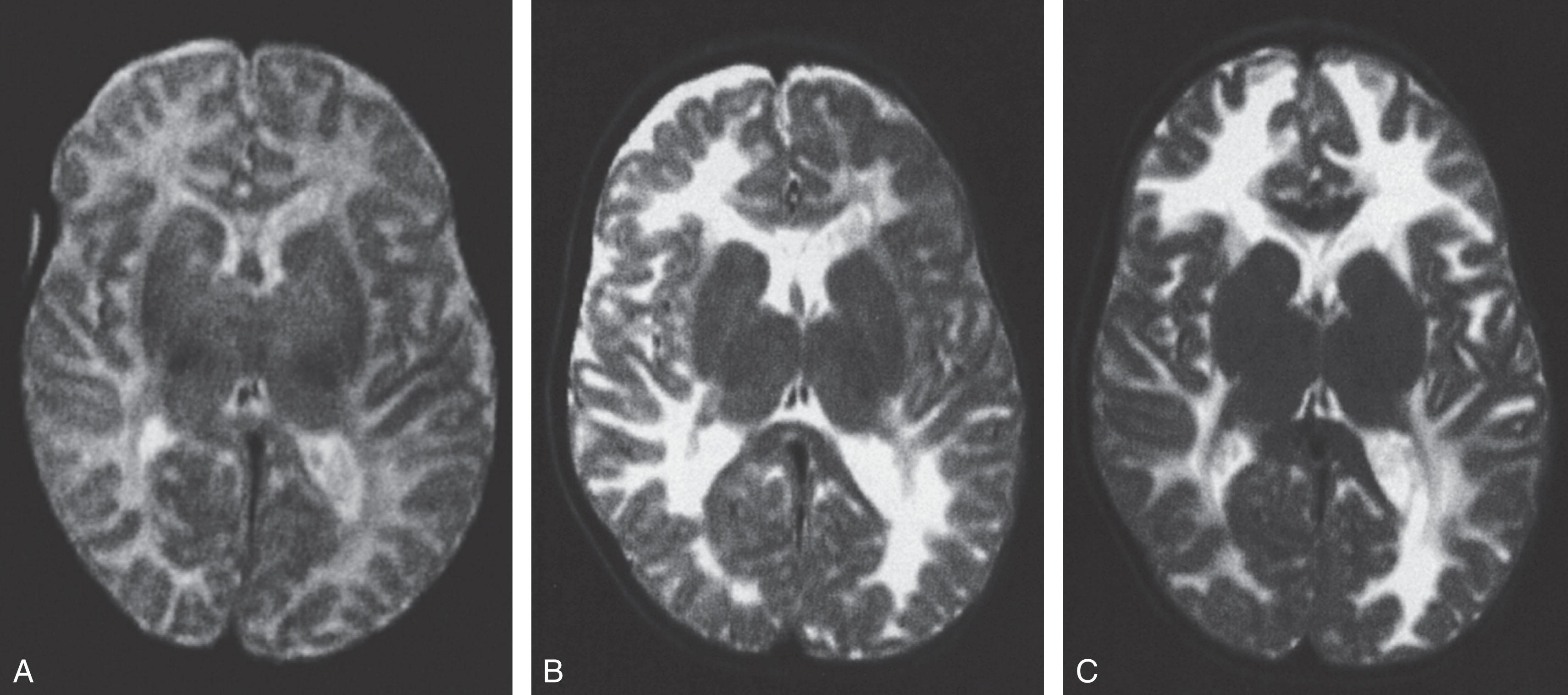 Fig. 37.8, Evolution of cerebral white matter abnormality in merosin-deficient congenital muscular dystrophy, as demonstrated by magnetic resonance imaging (T2-weighted images) . (A) At 3 weeks of age, the appearance of cerebral white matter was within normal limits. (B) At 6 months of age, abnormal signal intensity in cerebral white matter was clearly apparent. (C) At 12 months of age, the white matter was extremely abnormal.