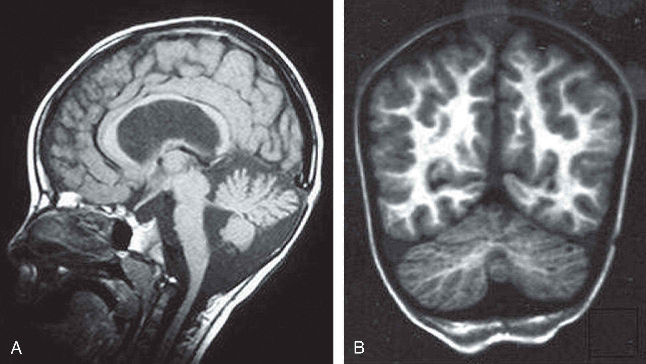 Fig. 37.9, CMD and cerebellar abnormalities with POMT2 mutations . (A) Enlarged cisterna magna and mild cerebellar vermis hypoplasia in a 16-month-old child with POMT2 mutations (sagittal T1-weighted brain MR image). (B) Cerebellar cysts in a 7-year-old with POMT2 mutations (coronal T1-weighted MR image).