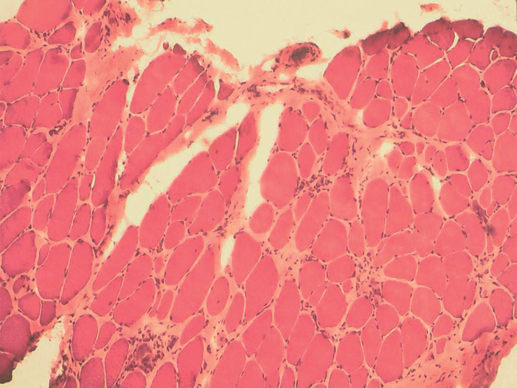 Fig. 37.10, Congenital muscular dystrophy: muscle pathology . Note nongrouped changes with marked variation in fiber size and extensive replacement of muscle by connective tissue (light brown areas) and fat (clear areas) . H&E stain, ×400.