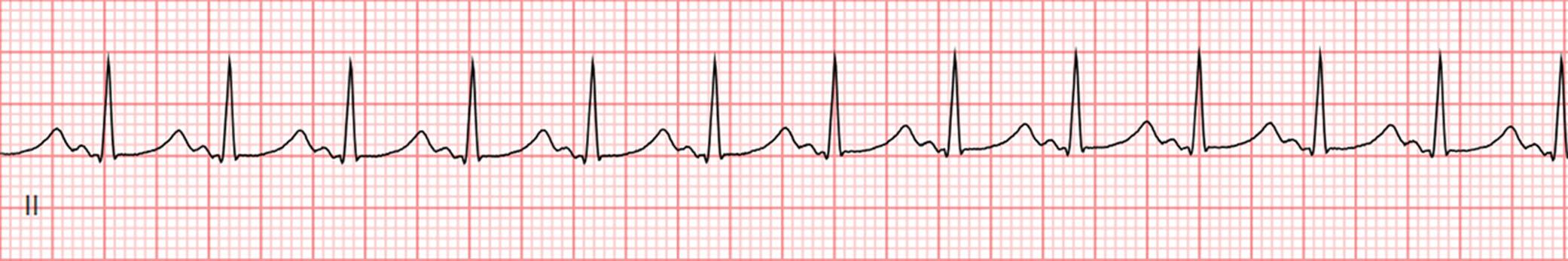 Fig. 60.1, Telemetry strip showing sinus tachycardia with a ventricular rate of 130 bpm and prolonged QT interval.