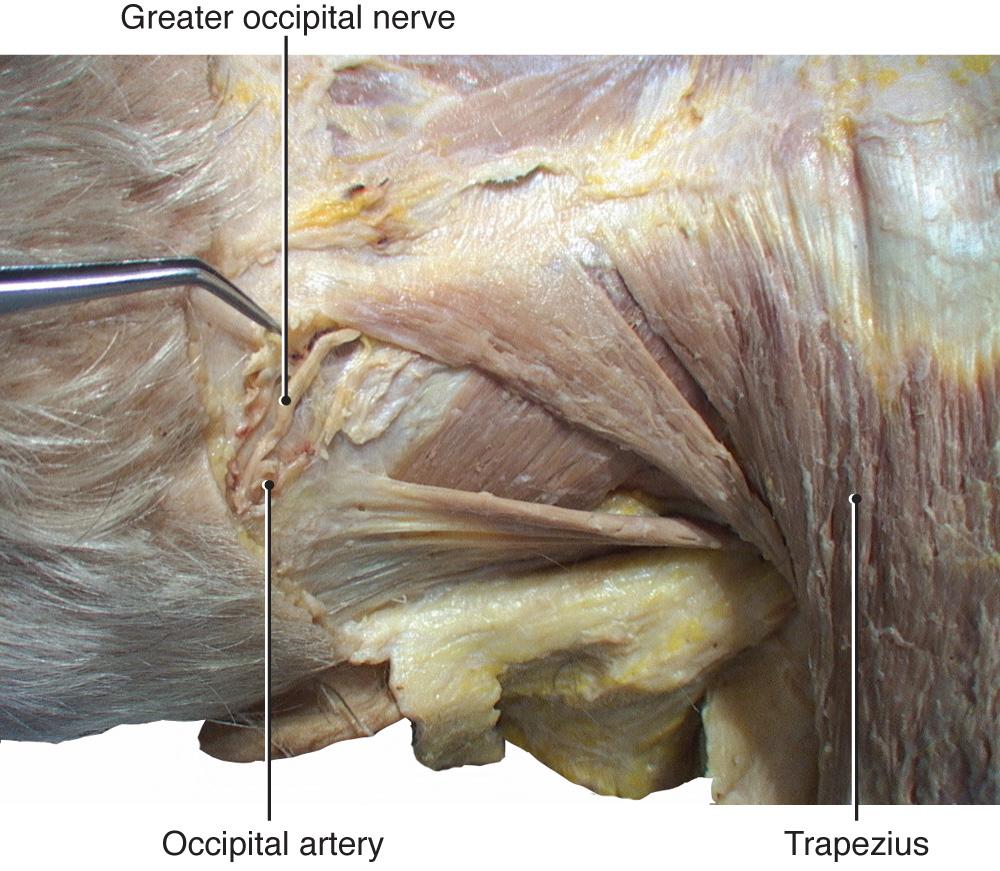 Fig. 2.12, Deep fascia is cut, and the greater occipital nerve and occipital artery are visible.