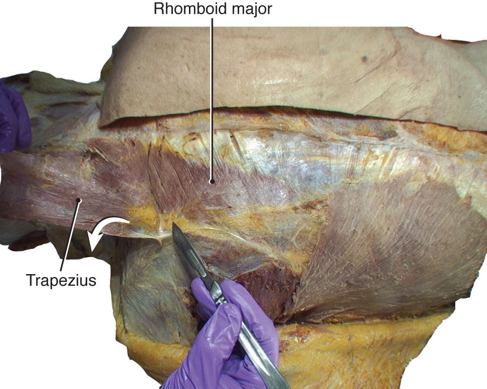 Fig. 2.15, Separation of the connective tissue on the deep surface of trapezius.