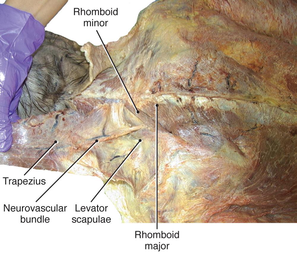 Fig. 2.16, Complete reflection of the trapezius and appearance of the underlying levator scapulae and rhomboid muscles, and neuromuscular bundle.