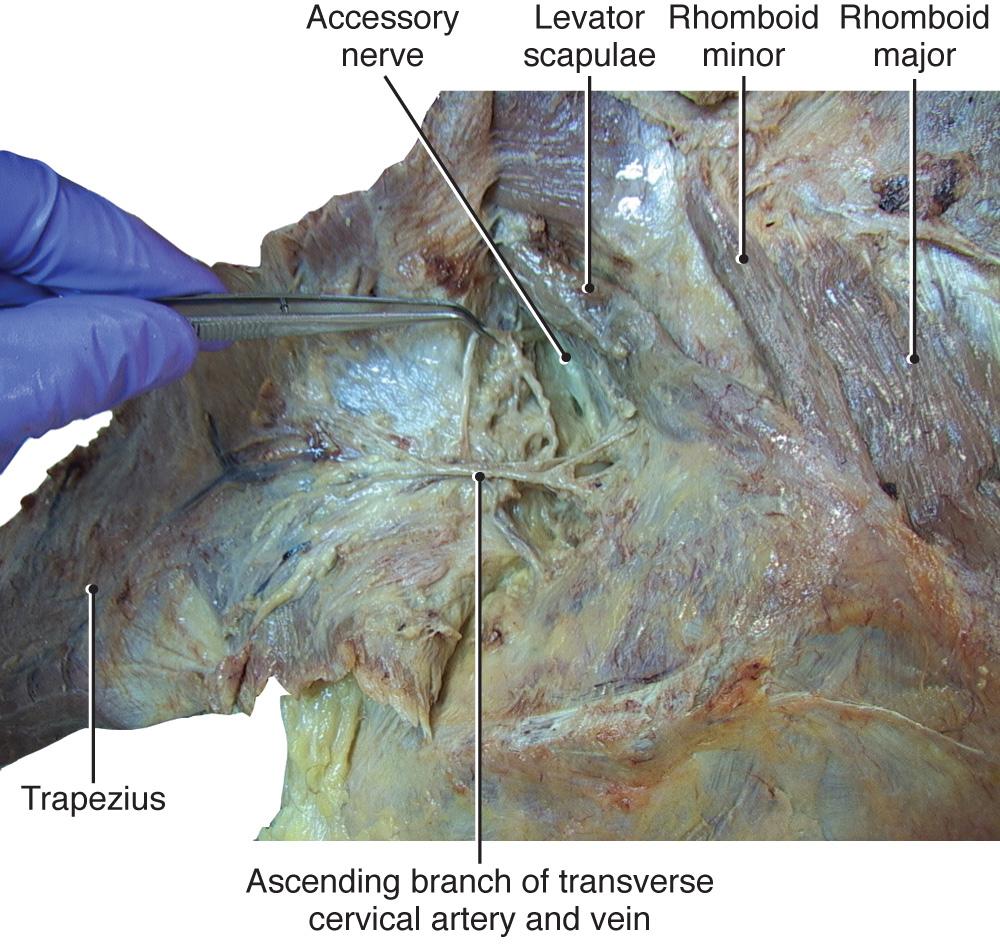 Fig. 2.17, Identification of accessory nerve, emerging deep from medial side at midpoint of levator scapulae muscle.