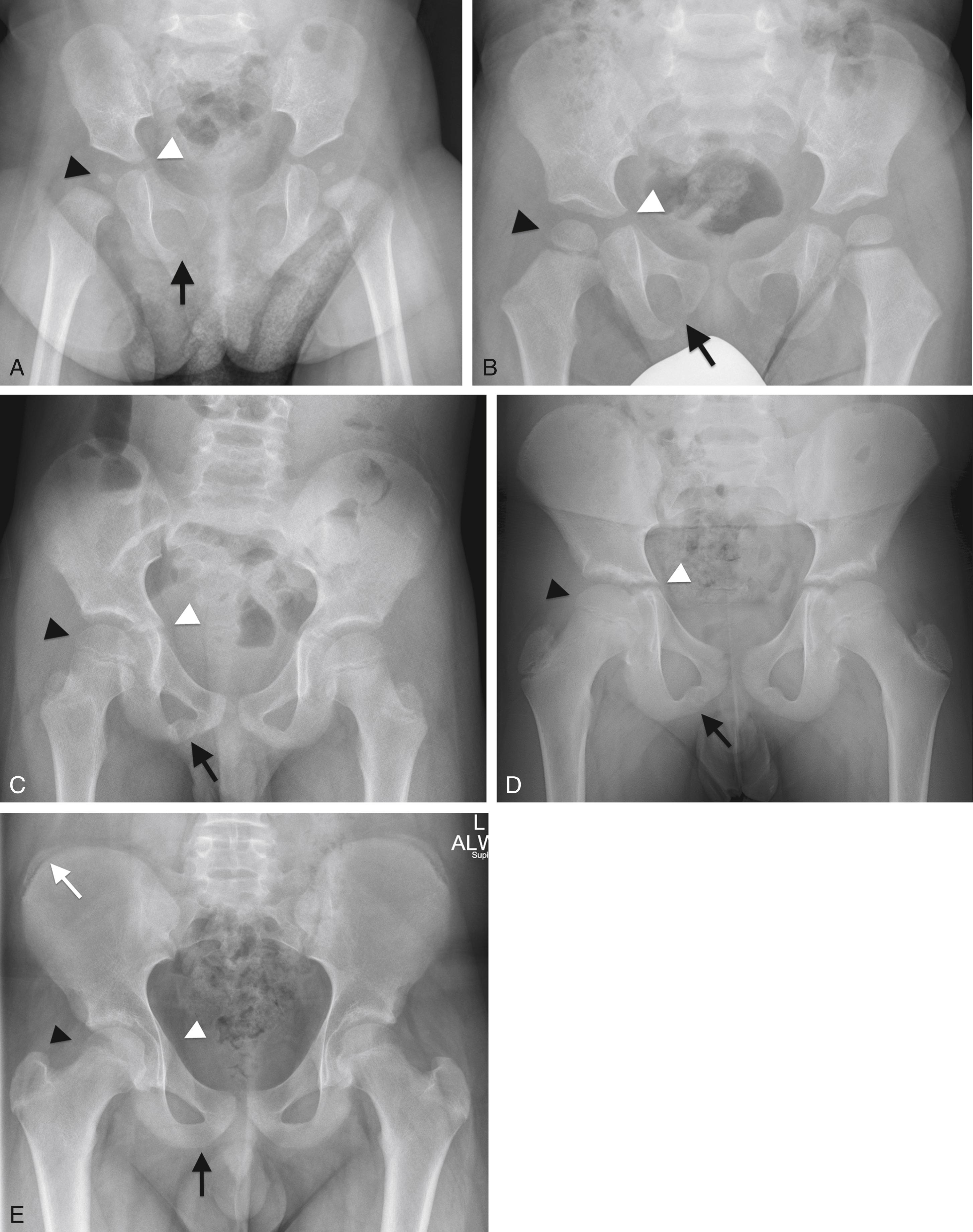 FIGURE 7-1, Changes in radiographic appearance of bony structures with age.