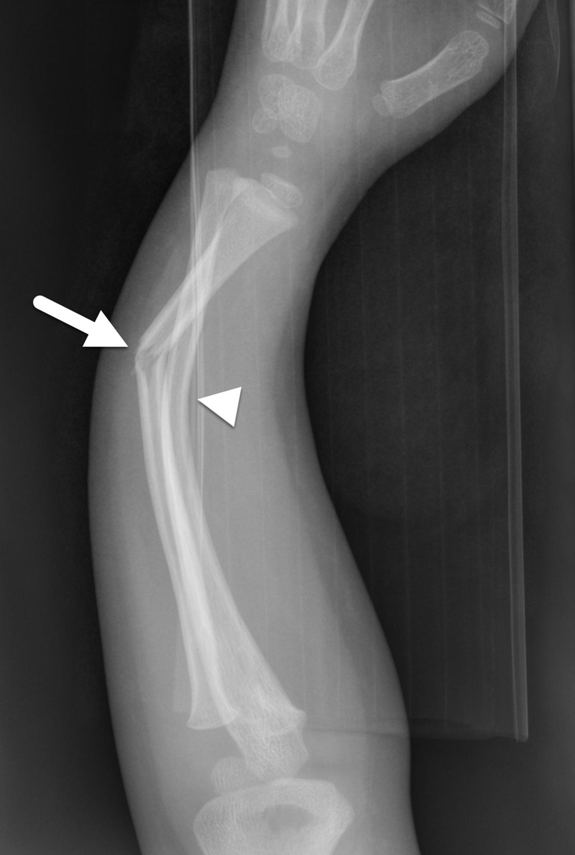 FIGURE 7-11, Plastic bowing deformity.