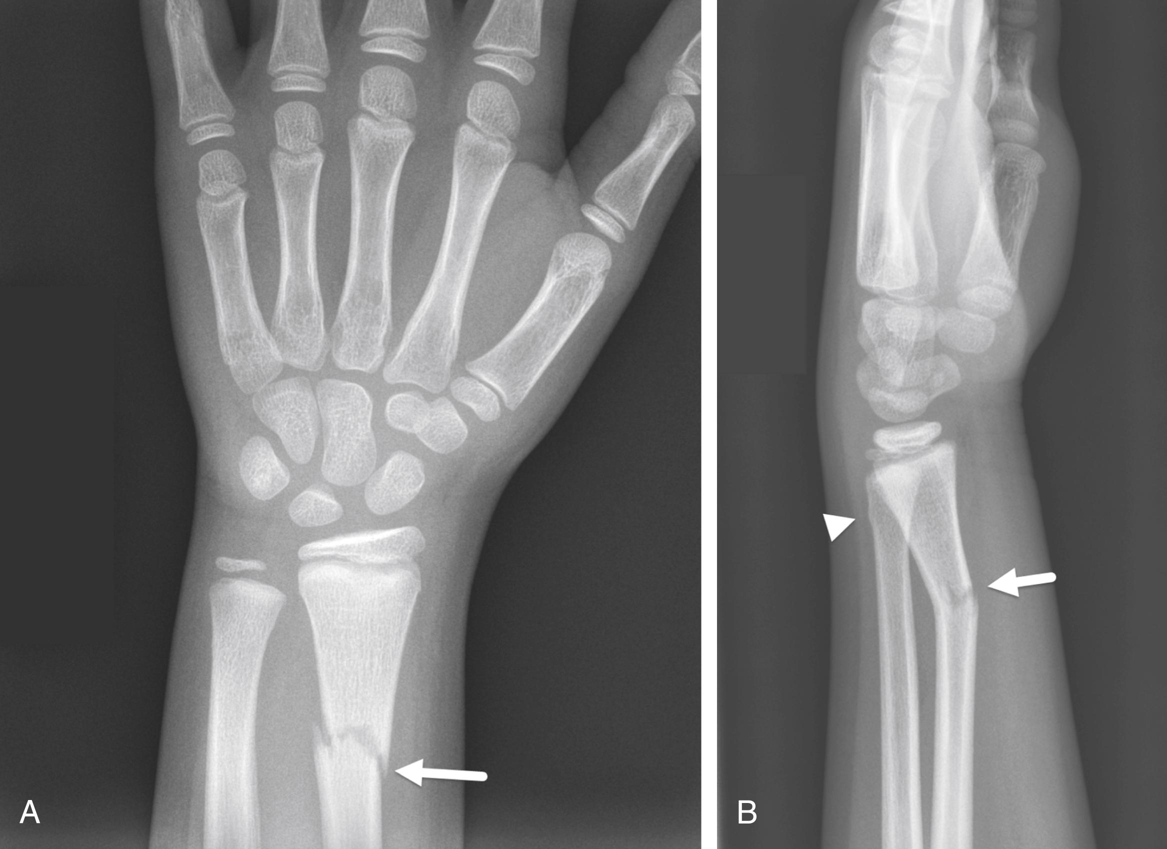 FIGURE 7-12, Buckle fracture of the distal ulna.