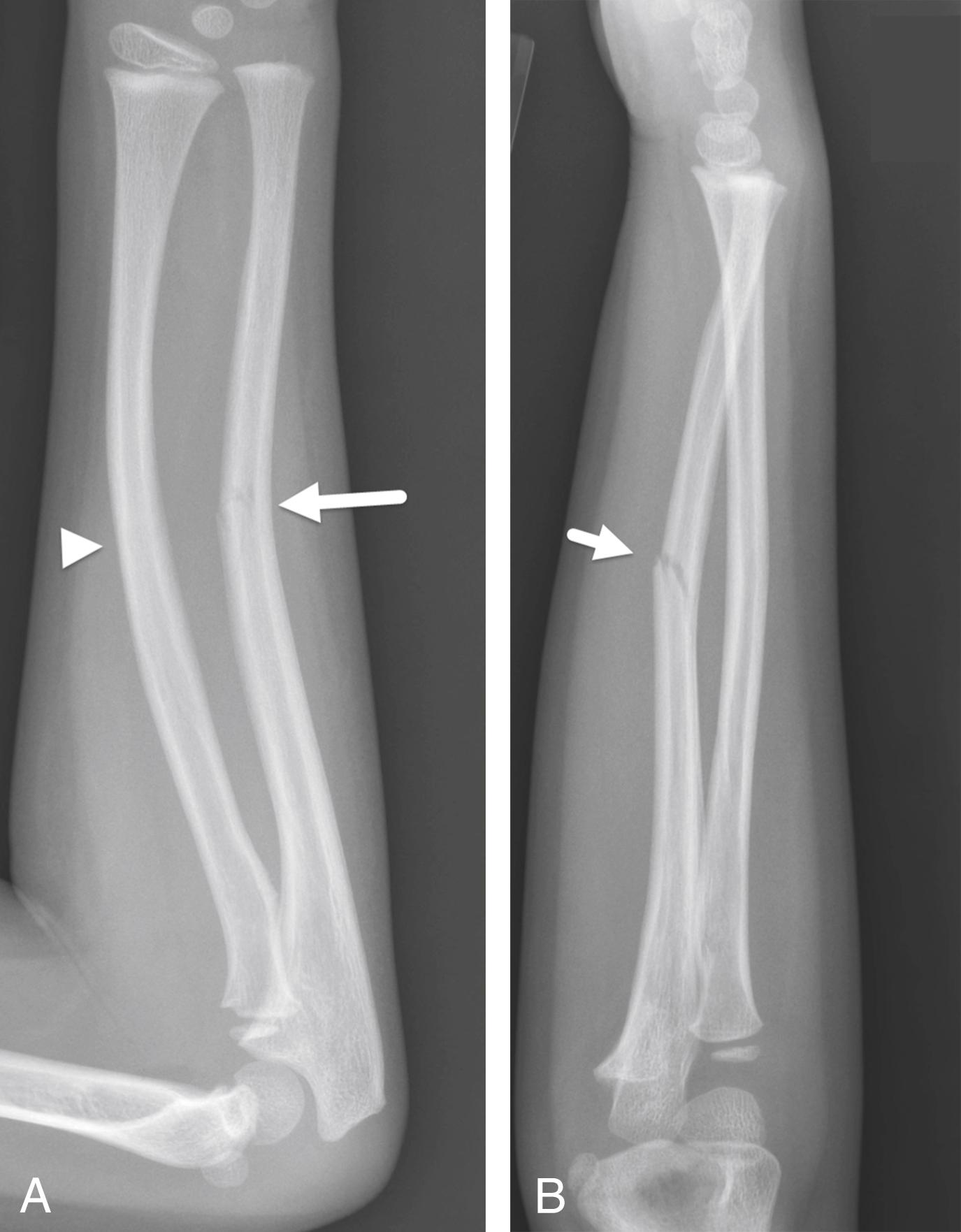 FIGURE 7-14, Greenstick fracture and plastic bowing injury.