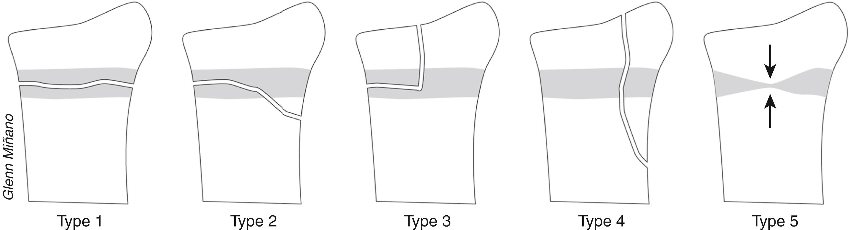 FIGURE 7-15, Diagram showing Salter–Harris classification of fractures involving the physis.