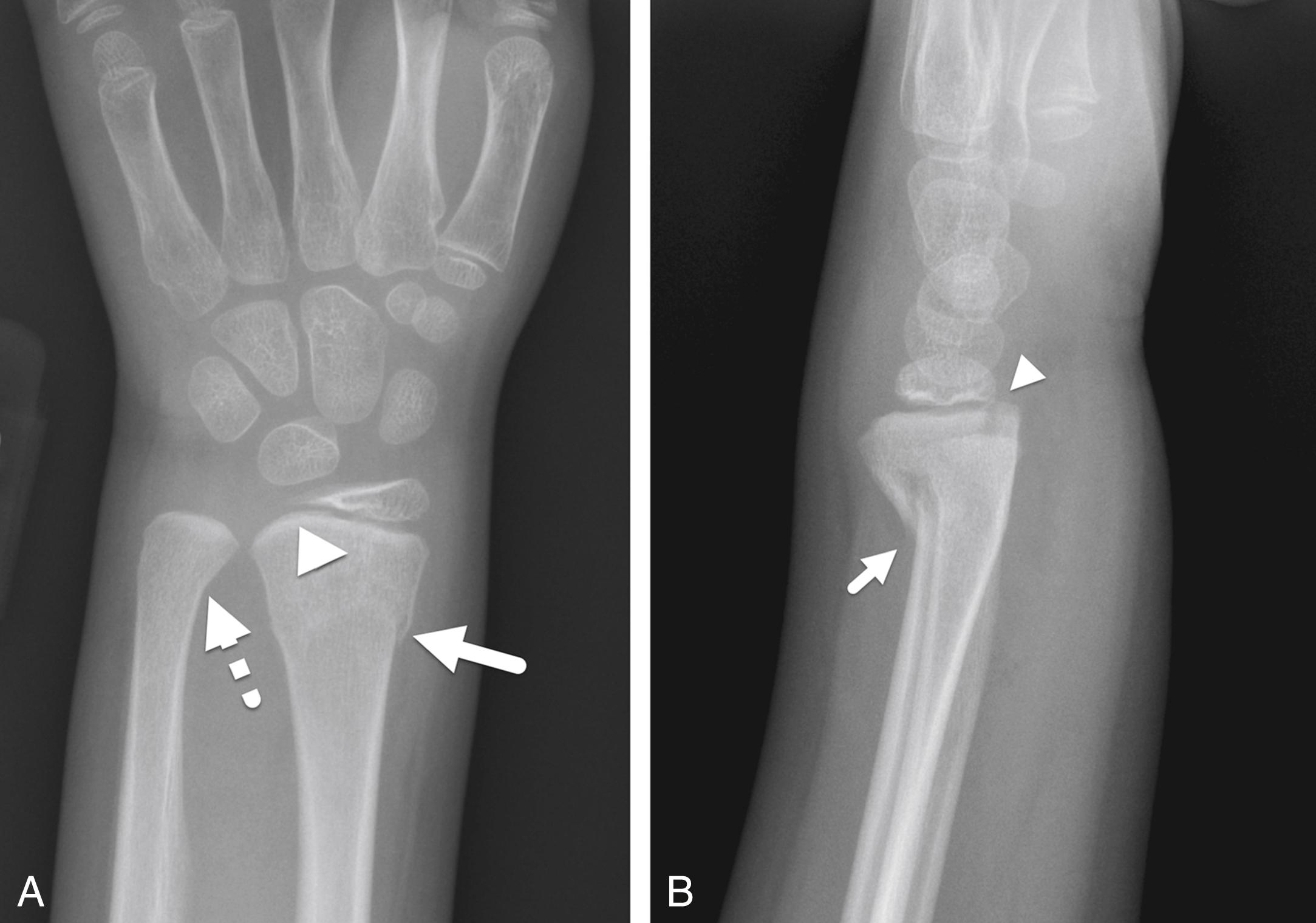 FIGURE 7-17, Salter–Harris type II fracture.