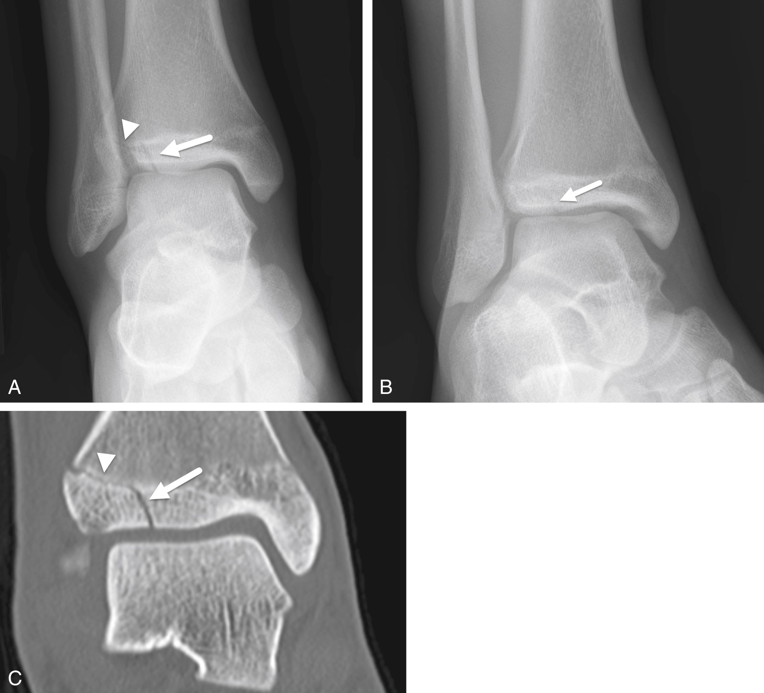 FIGURE 7-19, Salter–Harris type III fracture.