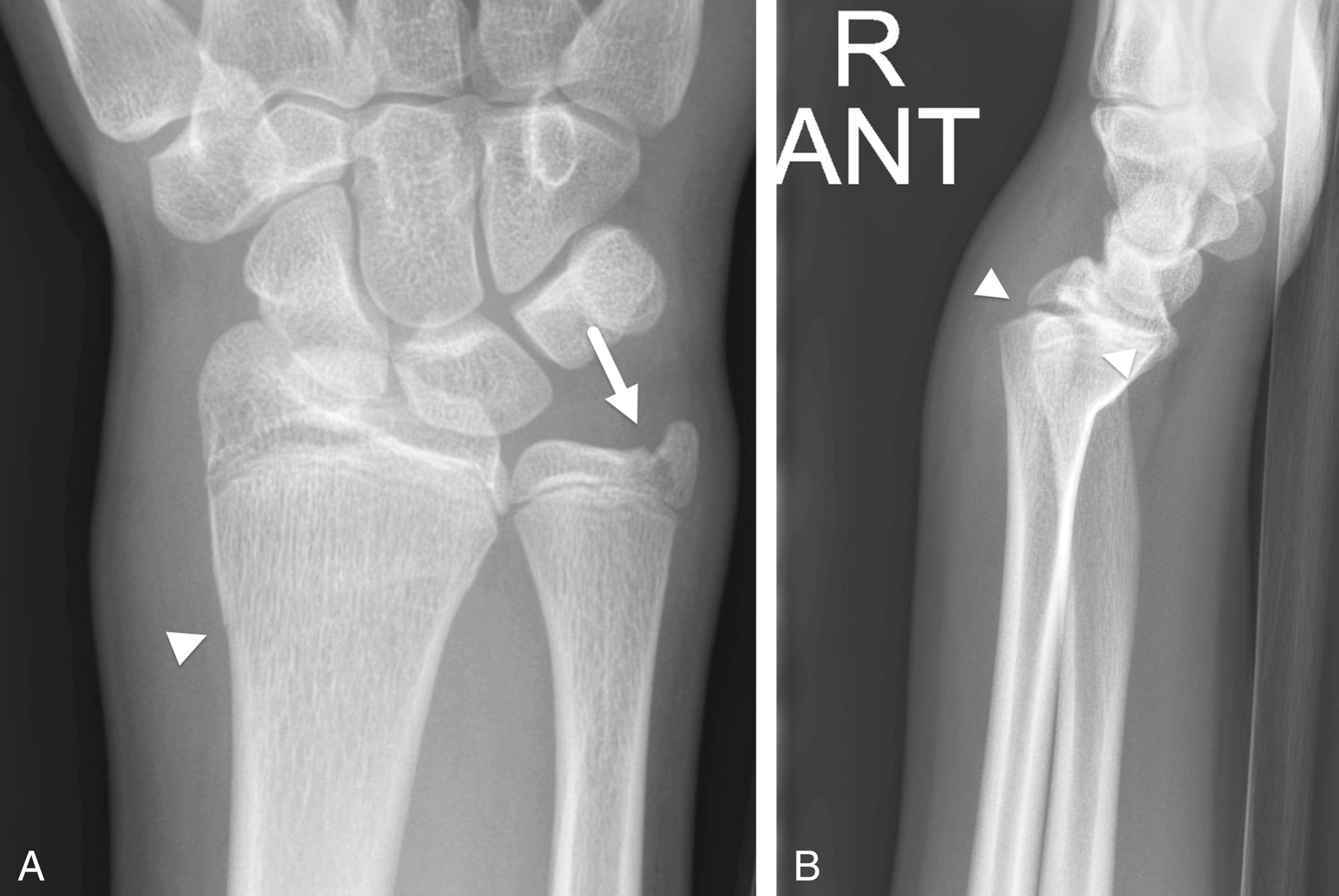 FIGURE 7-20, Salter–Harris type II and III fractures.