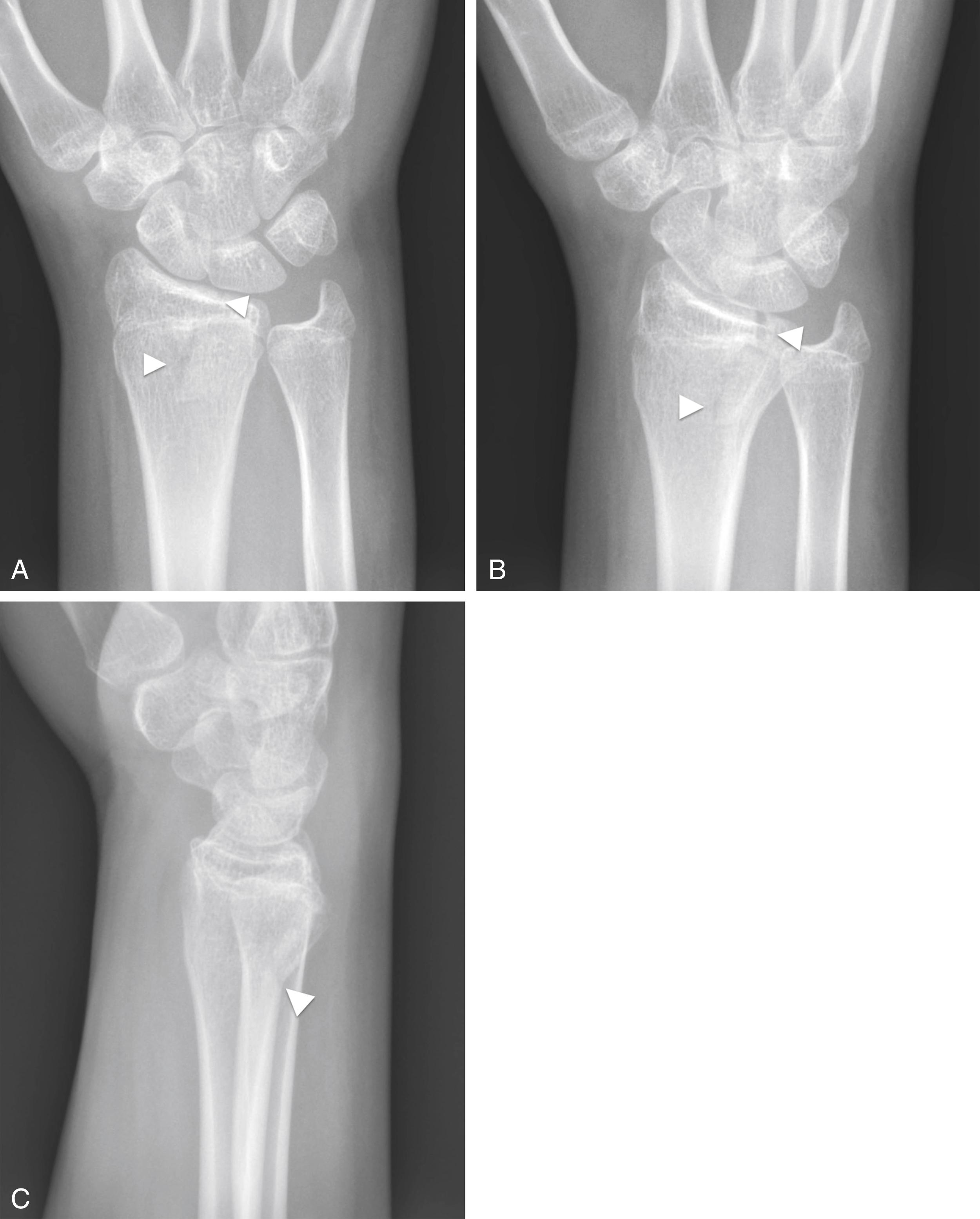 FIGURE 7-21, Salter–Harris type IV fracture.