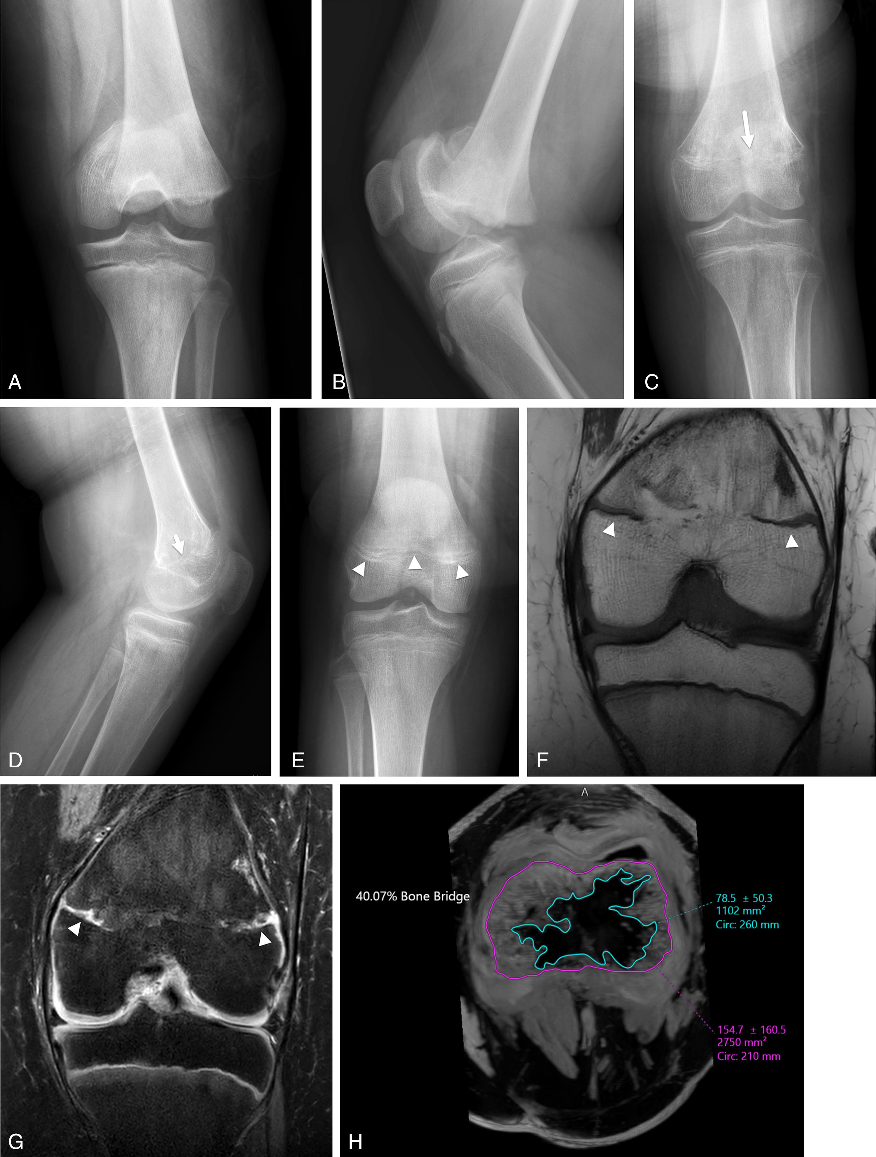 FIGURE 7-22, Premature physeal fusion secondary to a Salter–Harris type II fracture.