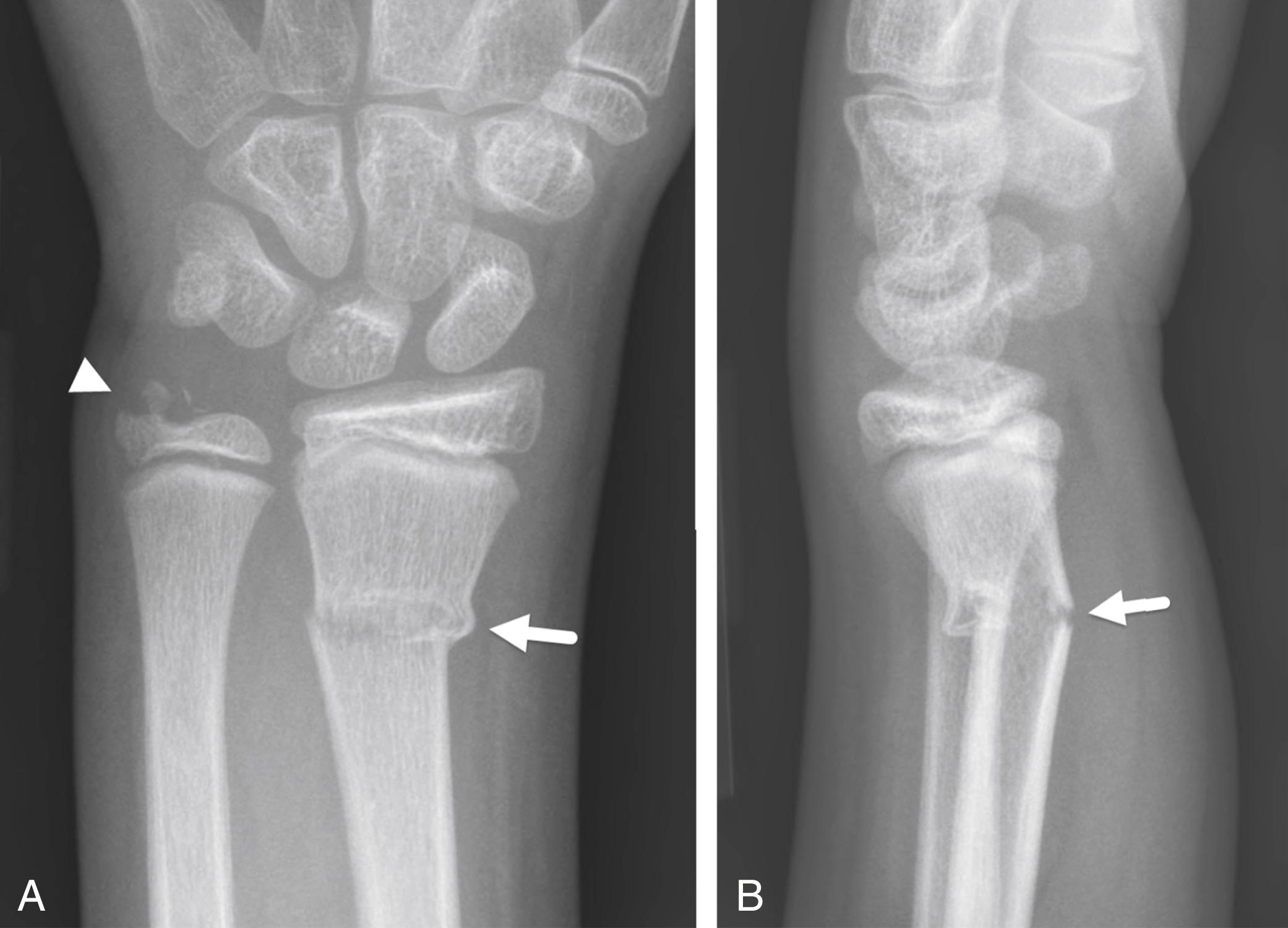 FIGURE 7-23, Transverse fracture of the distal radius and ulnar styloid.