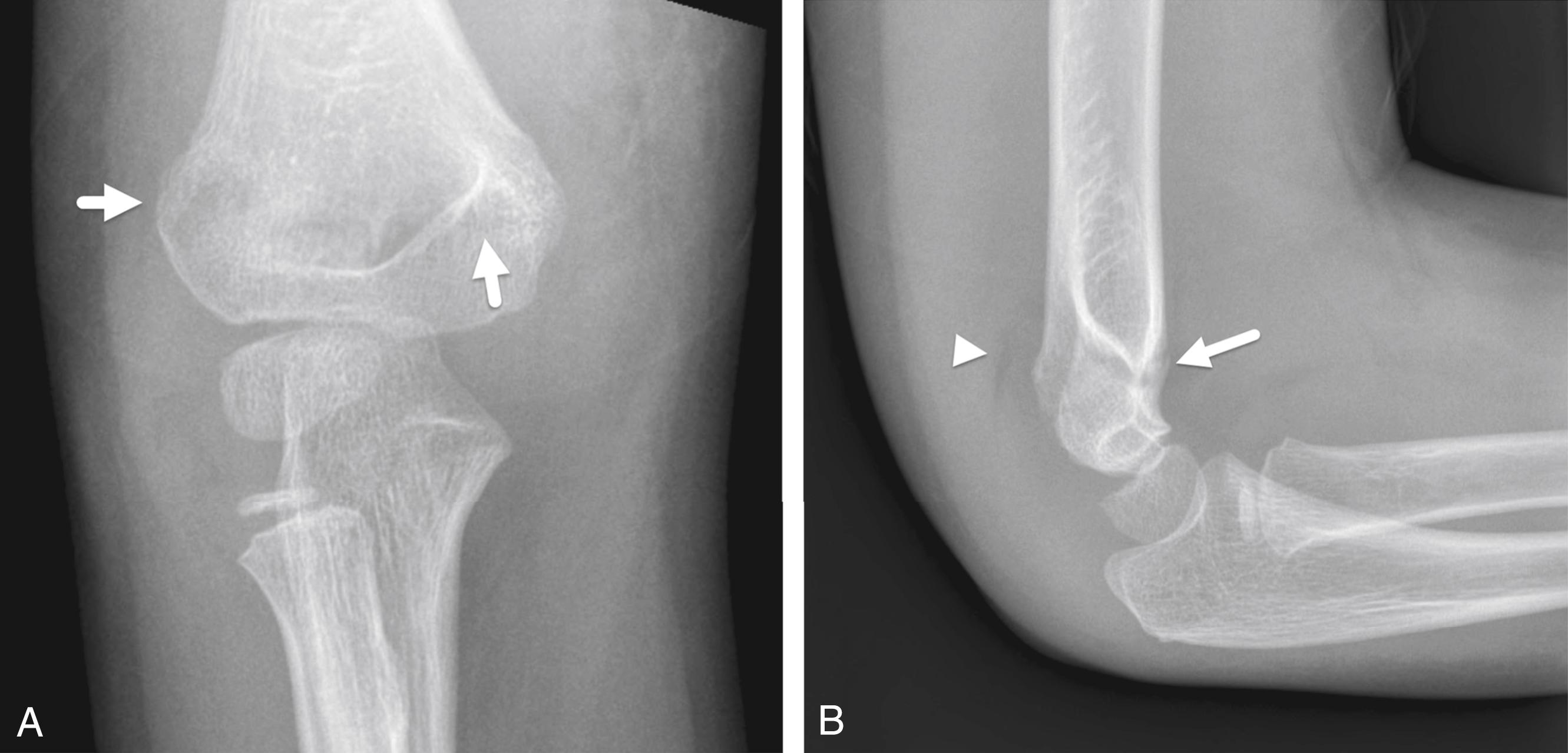 FIGURE 7-24, Supracondylar fracture.