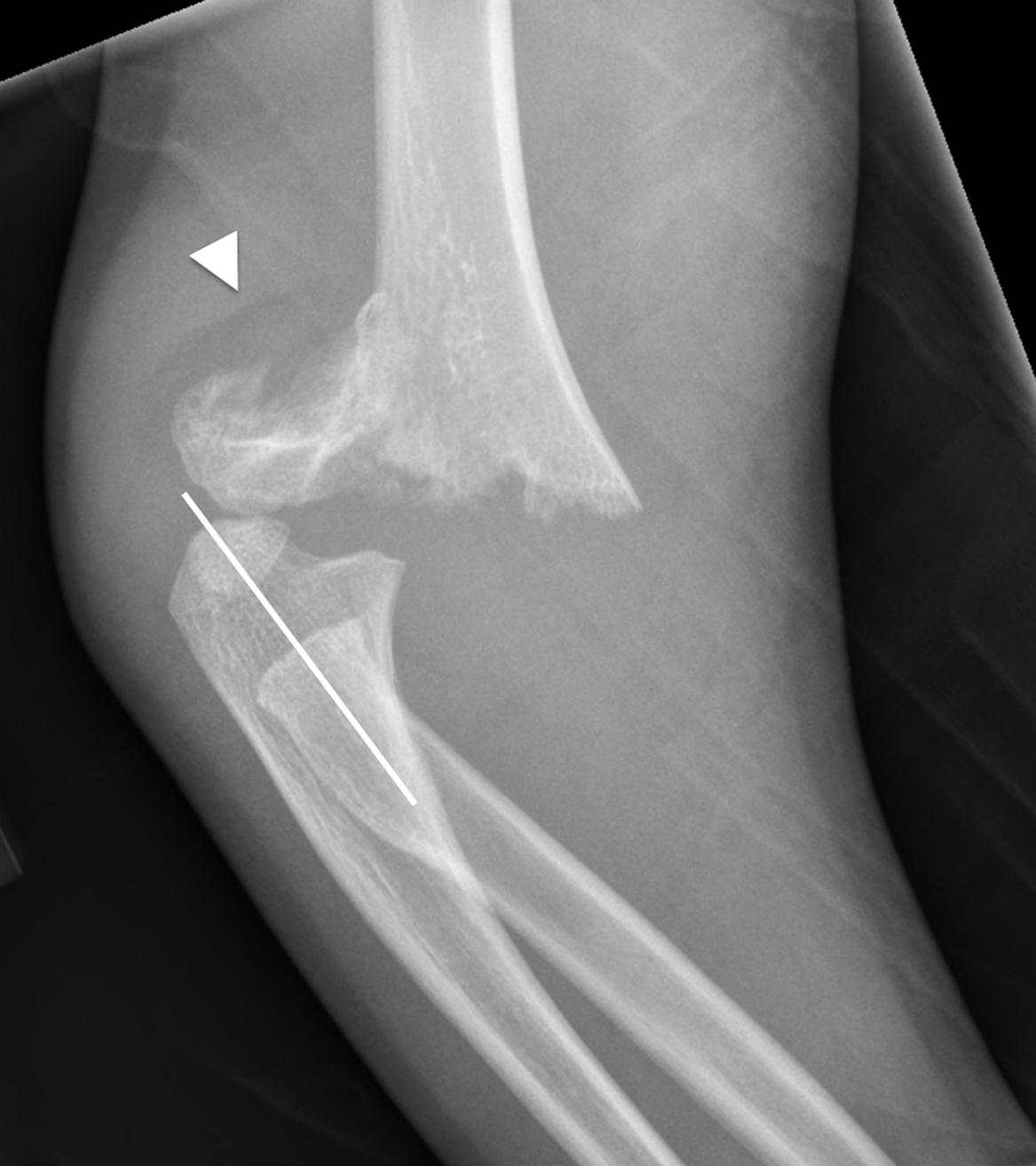 FIGURE 7-25, Supracondylar fracture.