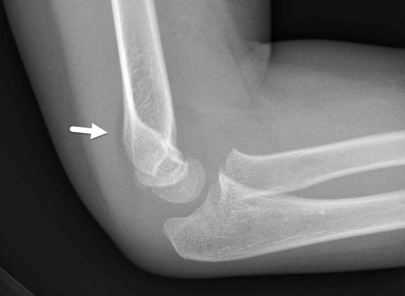 FIGURE 7-26, Elbow effusion.