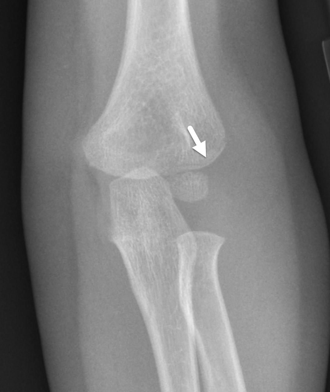 FIGURE 7-27, Lateral condylar fracture.