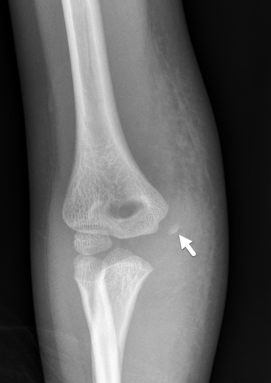 FIGURE 7-28, Medial epicondyle avulsion.