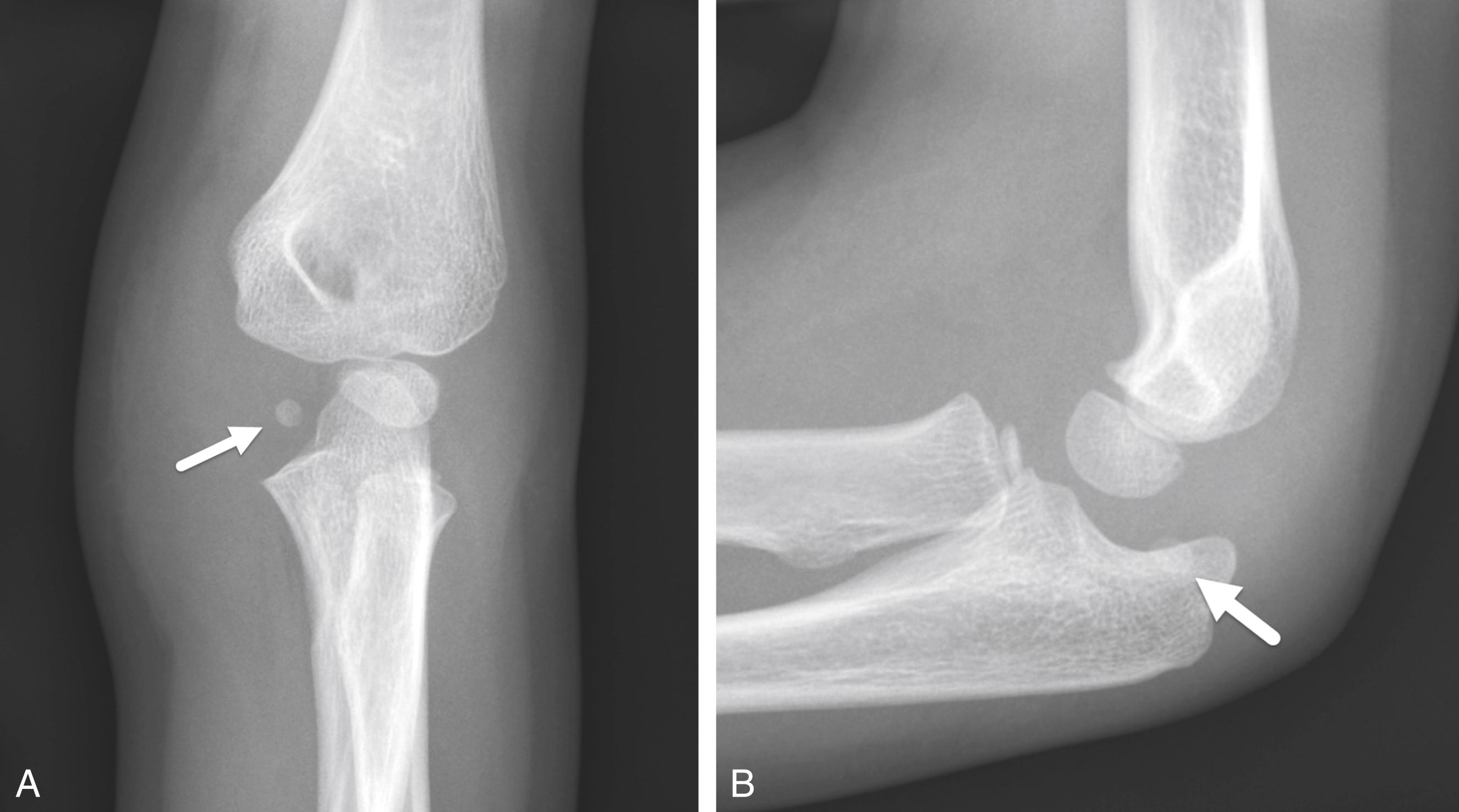 FIGURE 7-29, Avulsion and entrapment of the medial epicondyle.