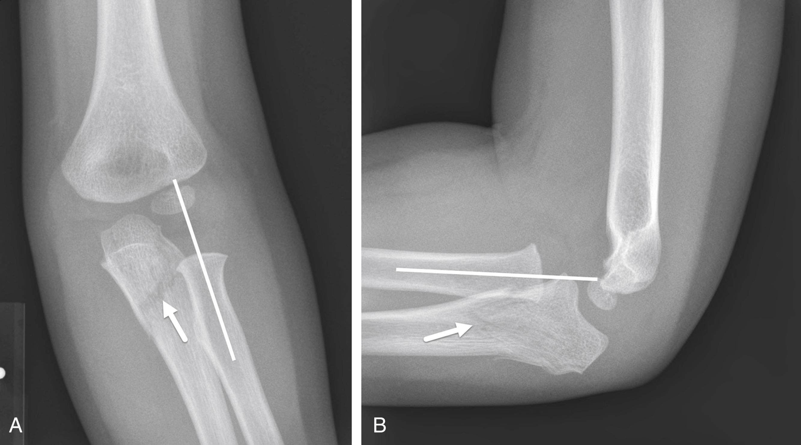 FIGURE 7-30, Monteggia fracture.