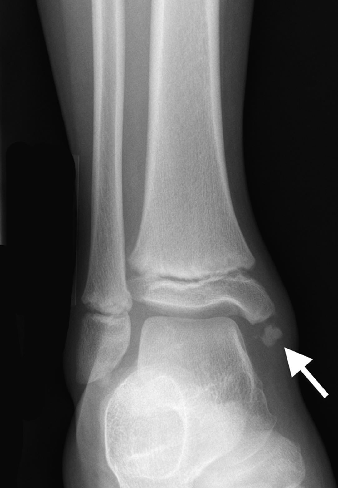 FIGURE 7-3, Apophyseal irregularity in the medial malleolus of the distal tibia.