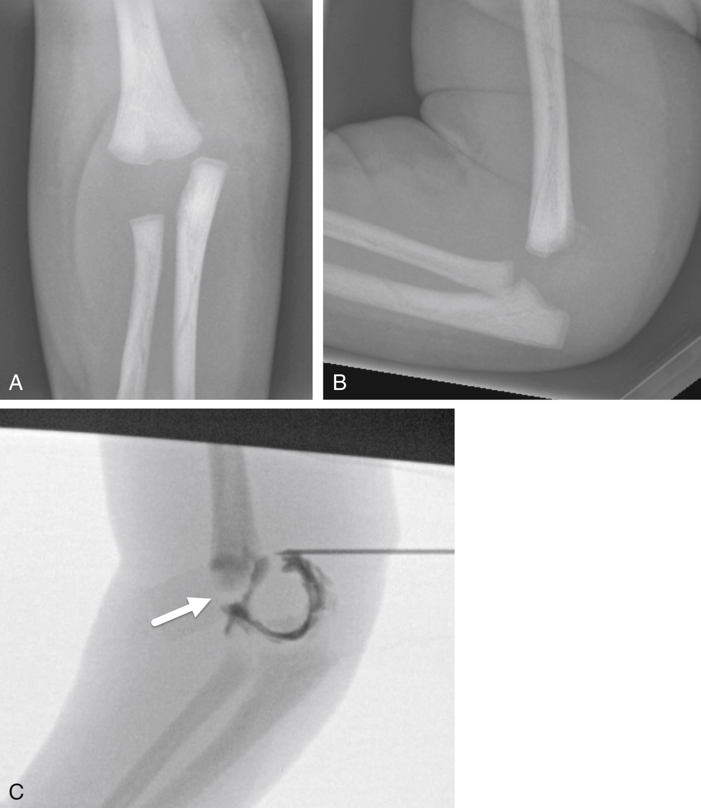 FIGURE 7-31, Distal humerus physeal separation.