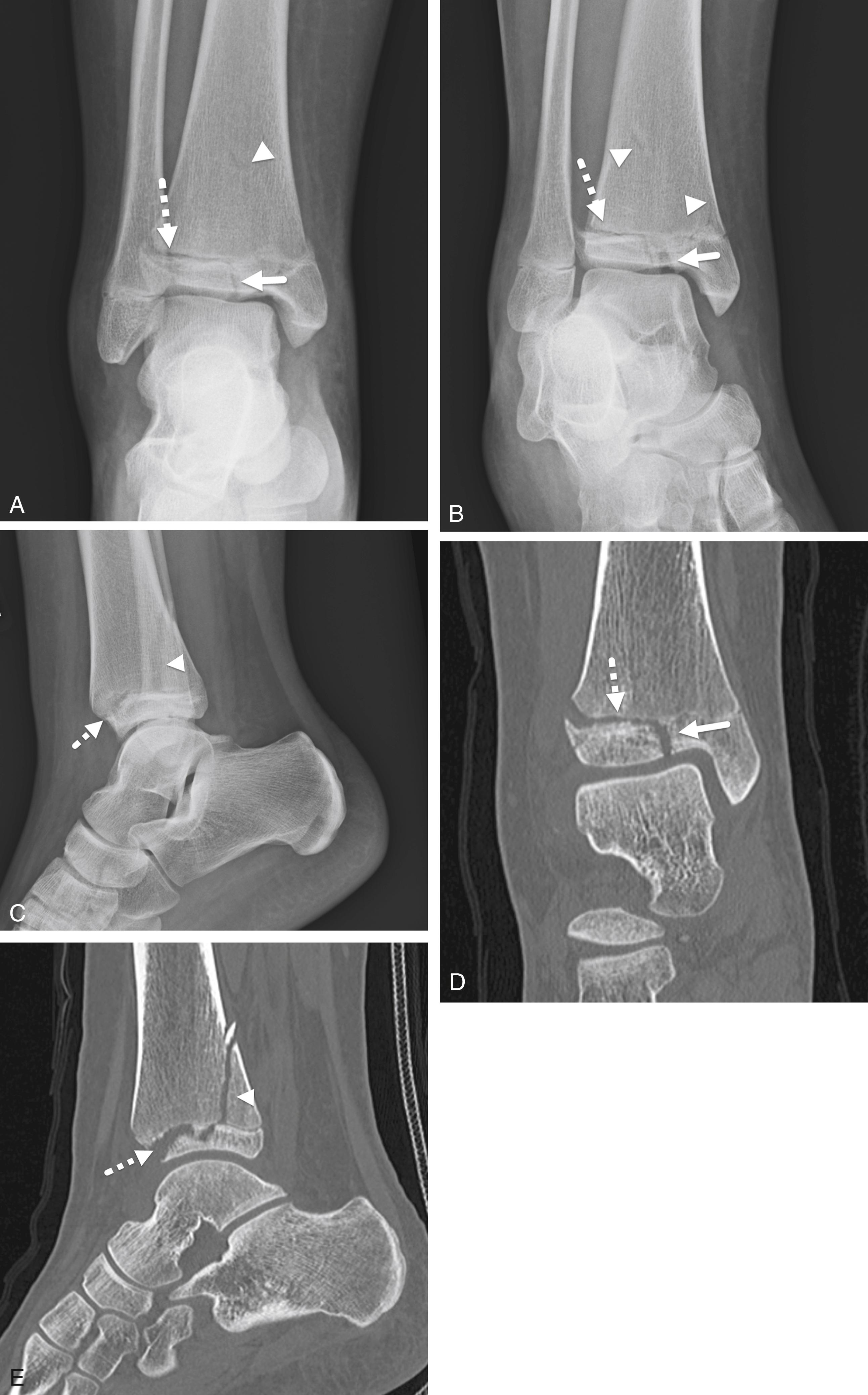 FIGURE 7-32, Triplane fracture.