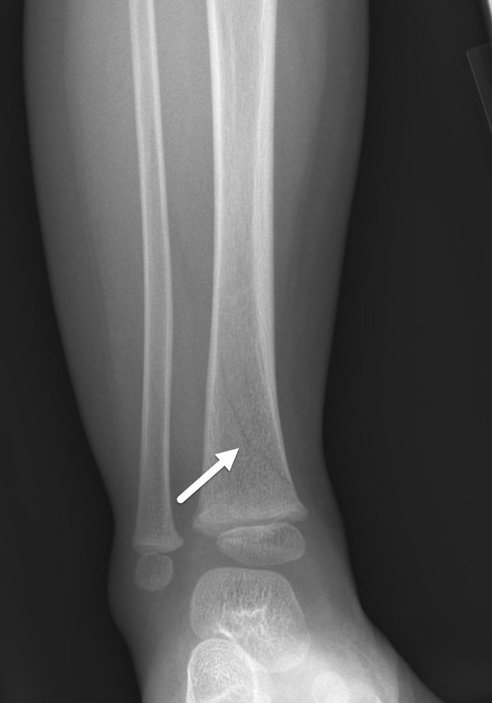 FIGURE 7-33, Spiral fracture of the tibia.