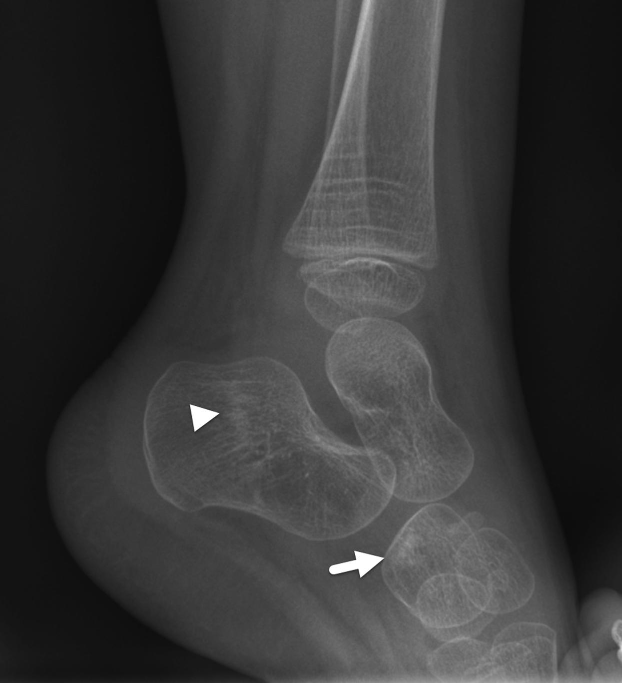 FIGURE 7-34, Stress fractures of the calcaneus and cuboid.