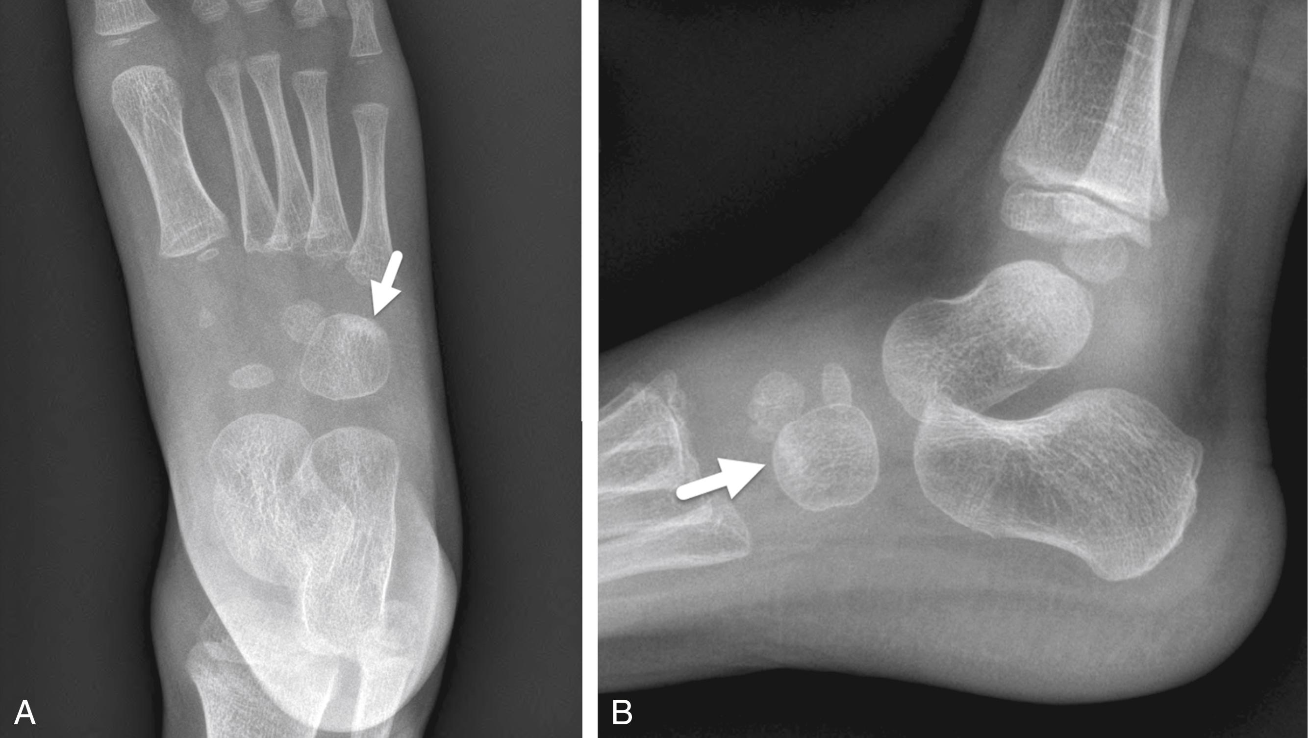 FIGURE 7-35, Stress fractures of the cuboid.