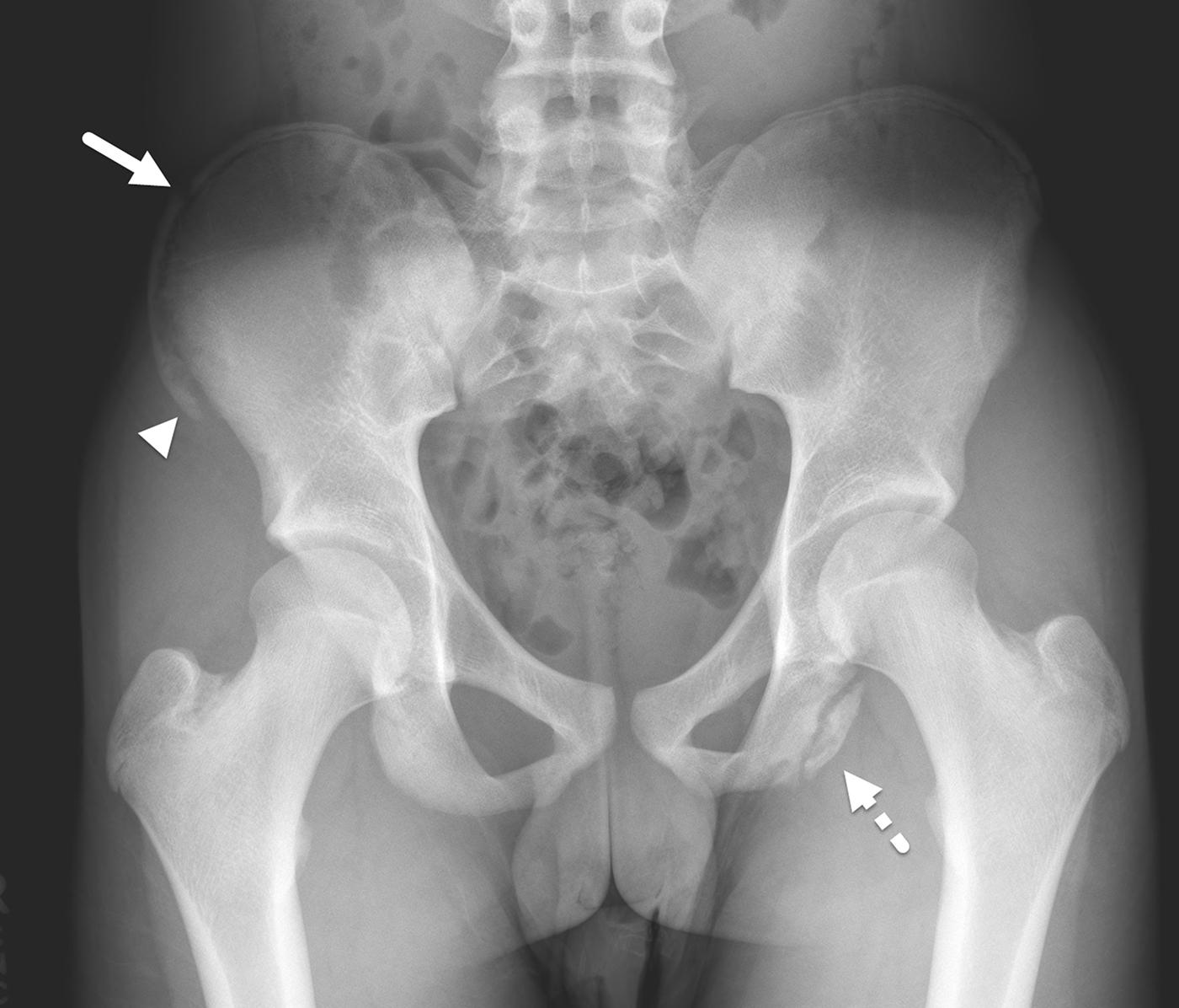 FIGURE 7-36, Multiple avulsion fractures of the pelvis.