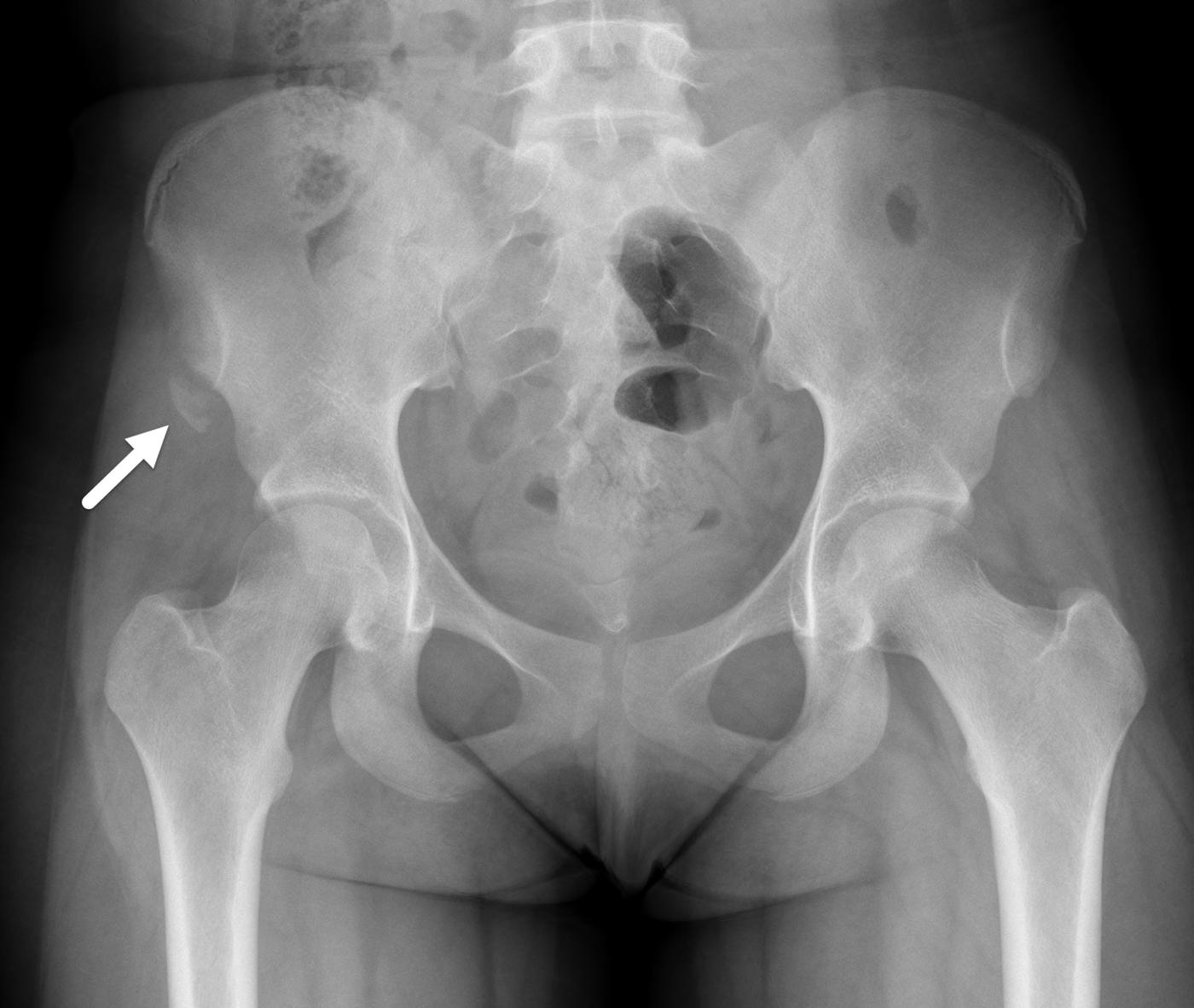 FIGURE 7-37, Avulsion fracture of the anterior superior iliac spine.