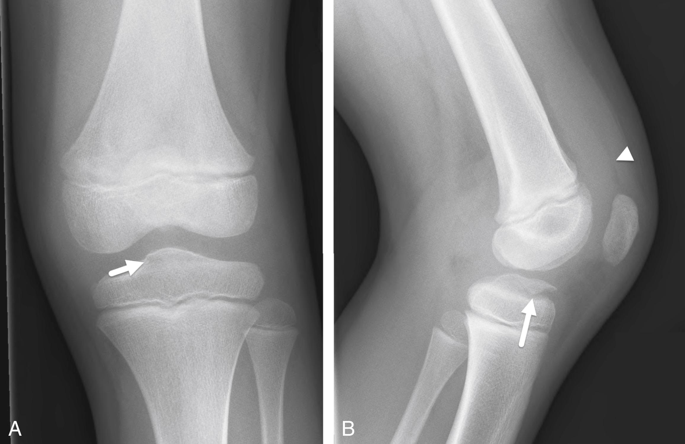 FIGURE 7-39, Tibial spine avulsion fracture.