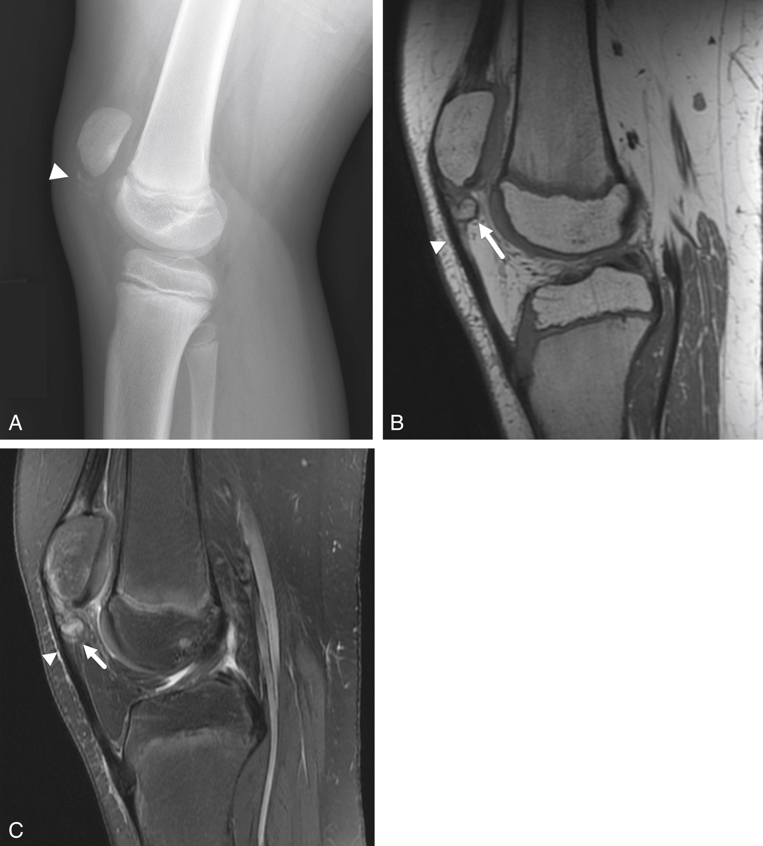 FIGURE 7-42, Patellar sleeve avulsion fracture.