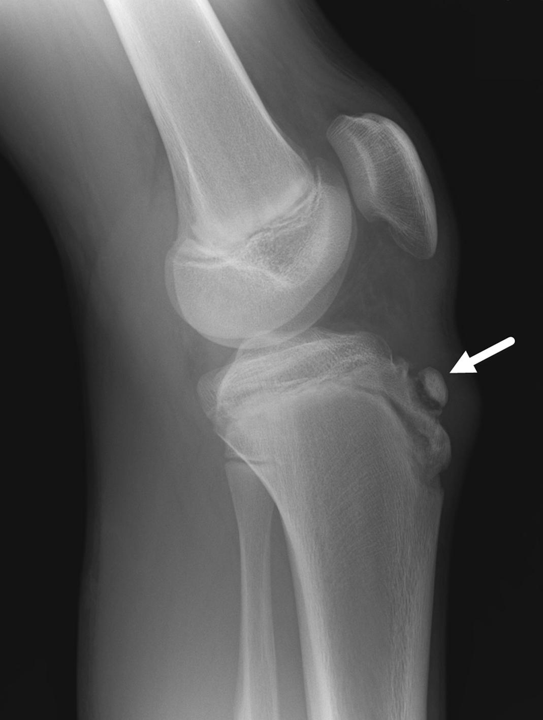 FIGURE 7-45, Osgood–Schlatter disease.